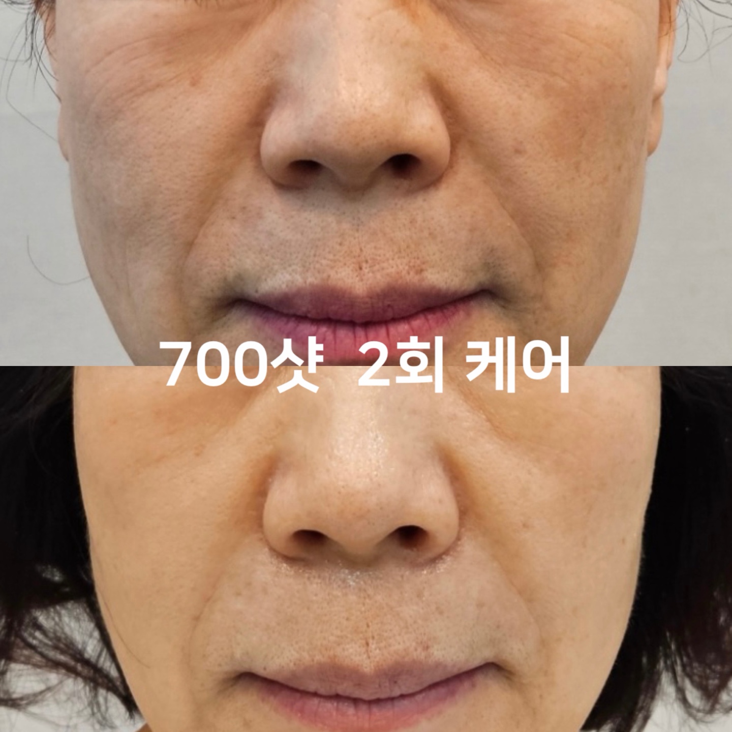 아비에 피부 대표 이미지