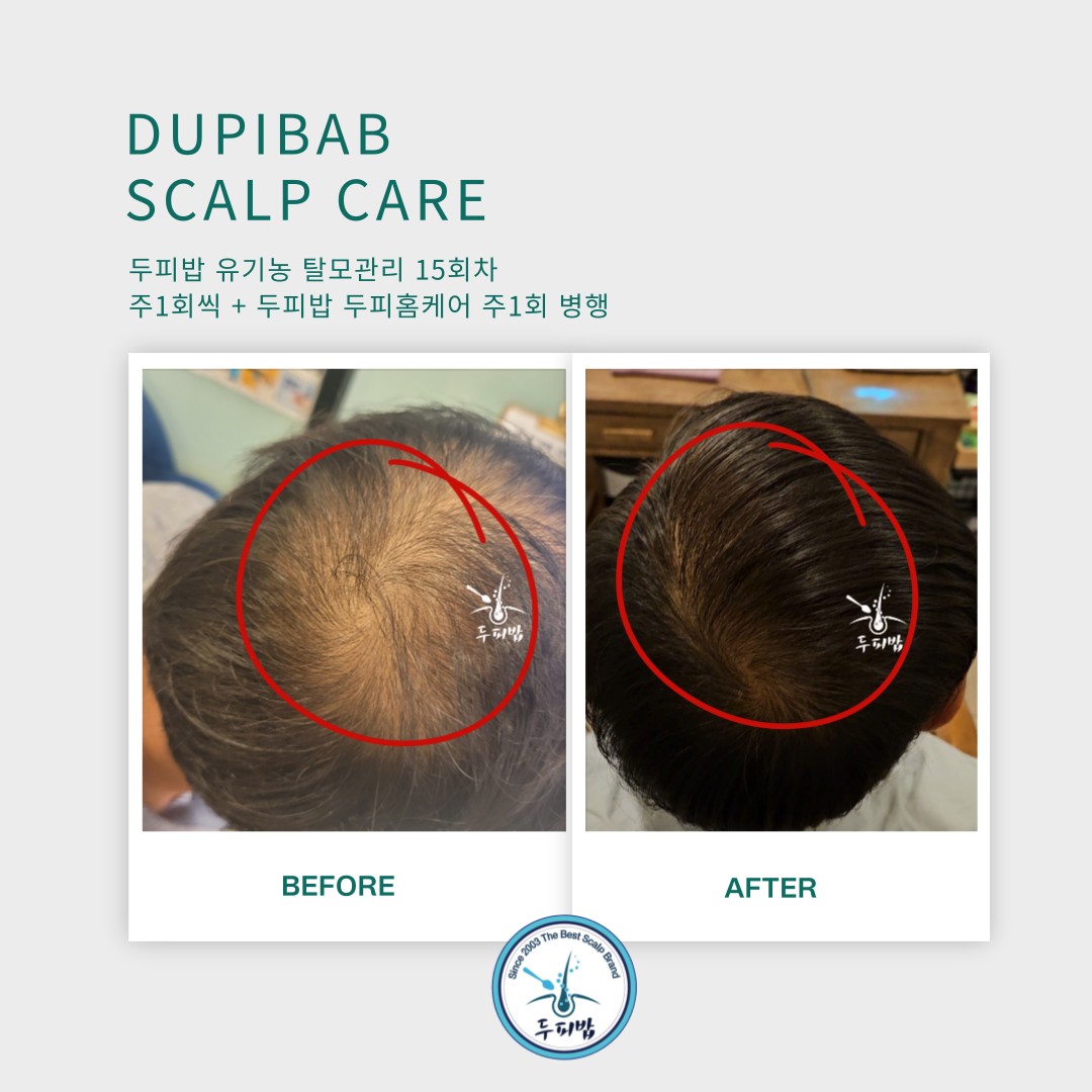 두피밥 대표 이미지