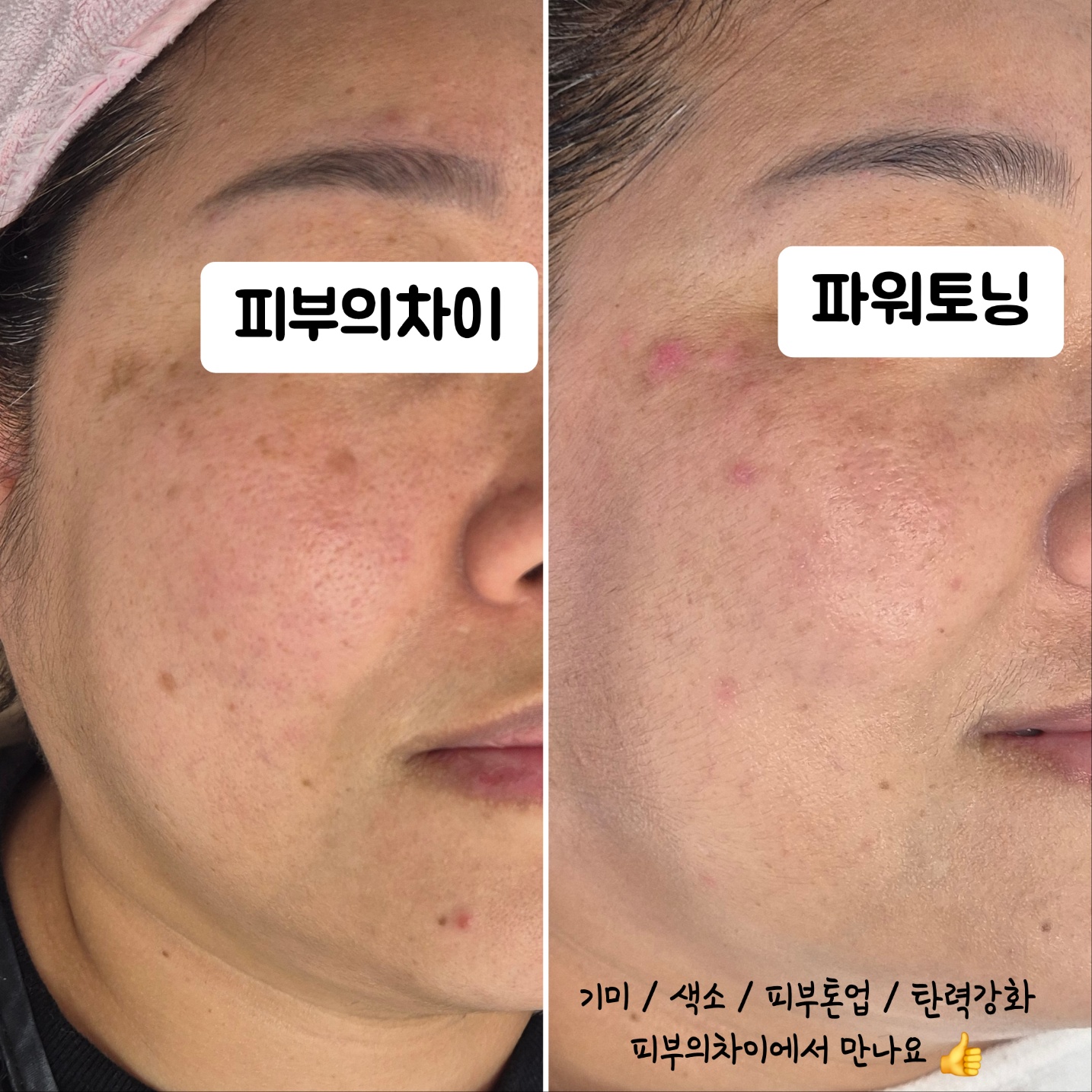피부의차이 photo 2