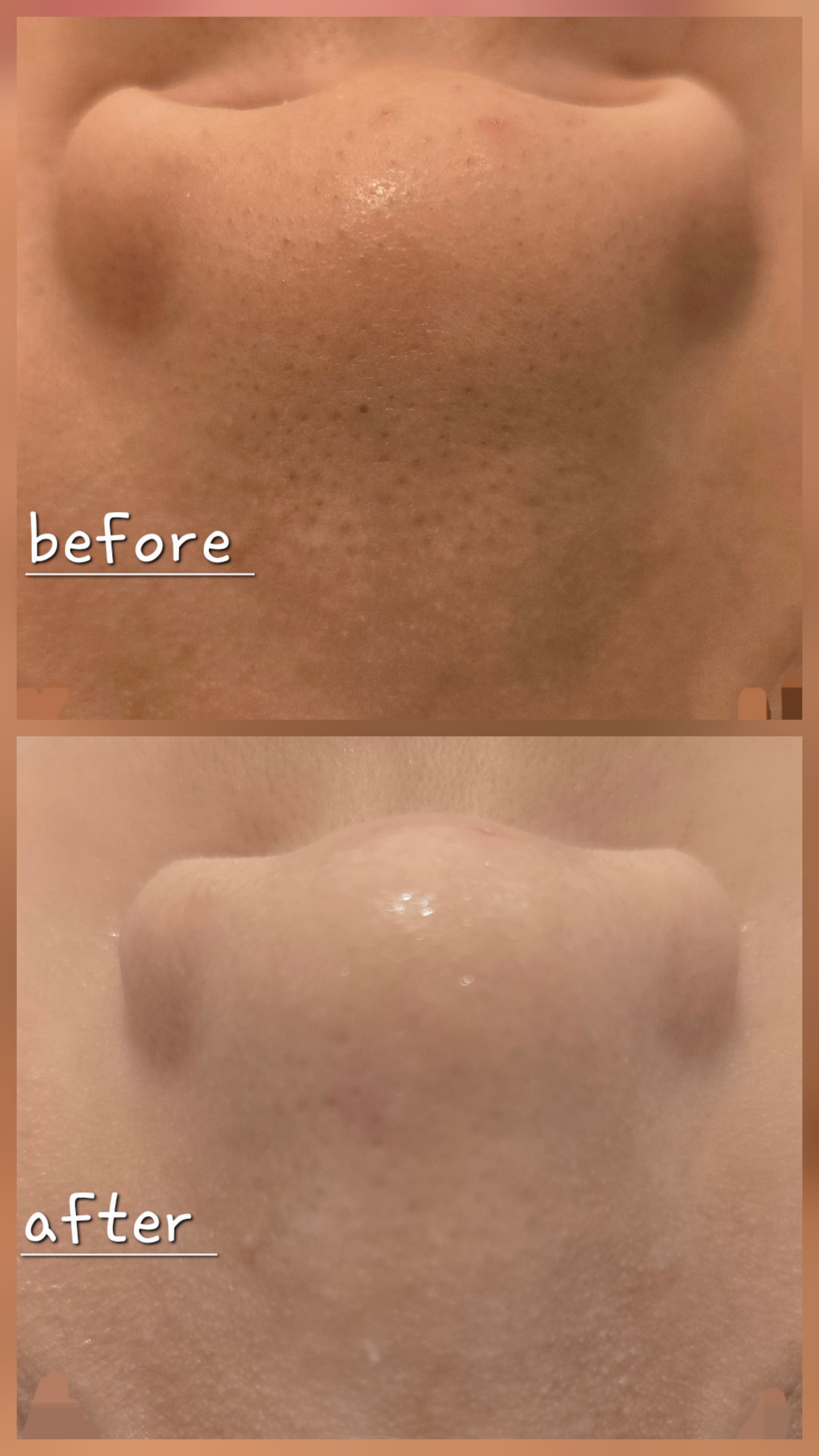 모공세척테라피 이미지