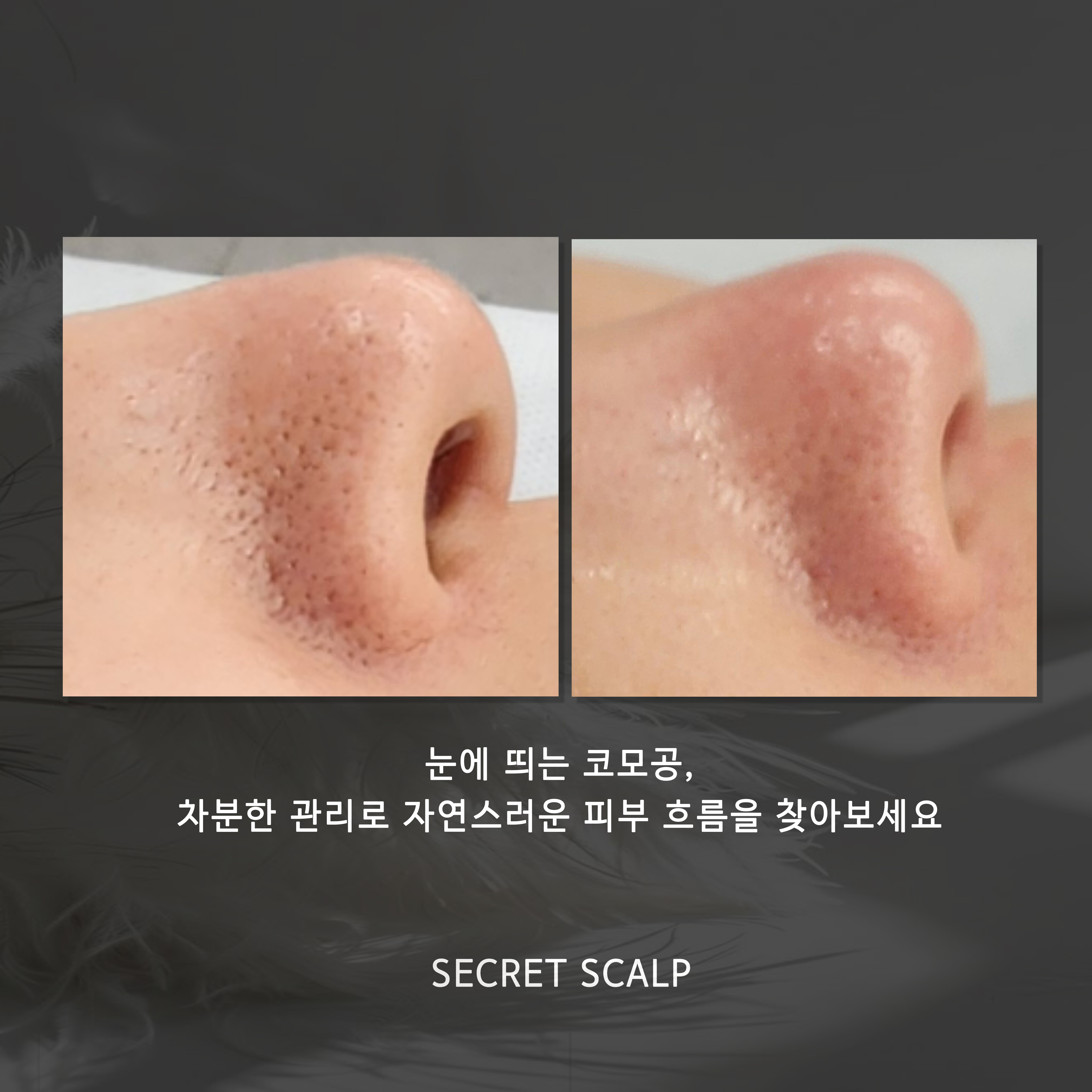 시크릿스칼프 대표 이미지