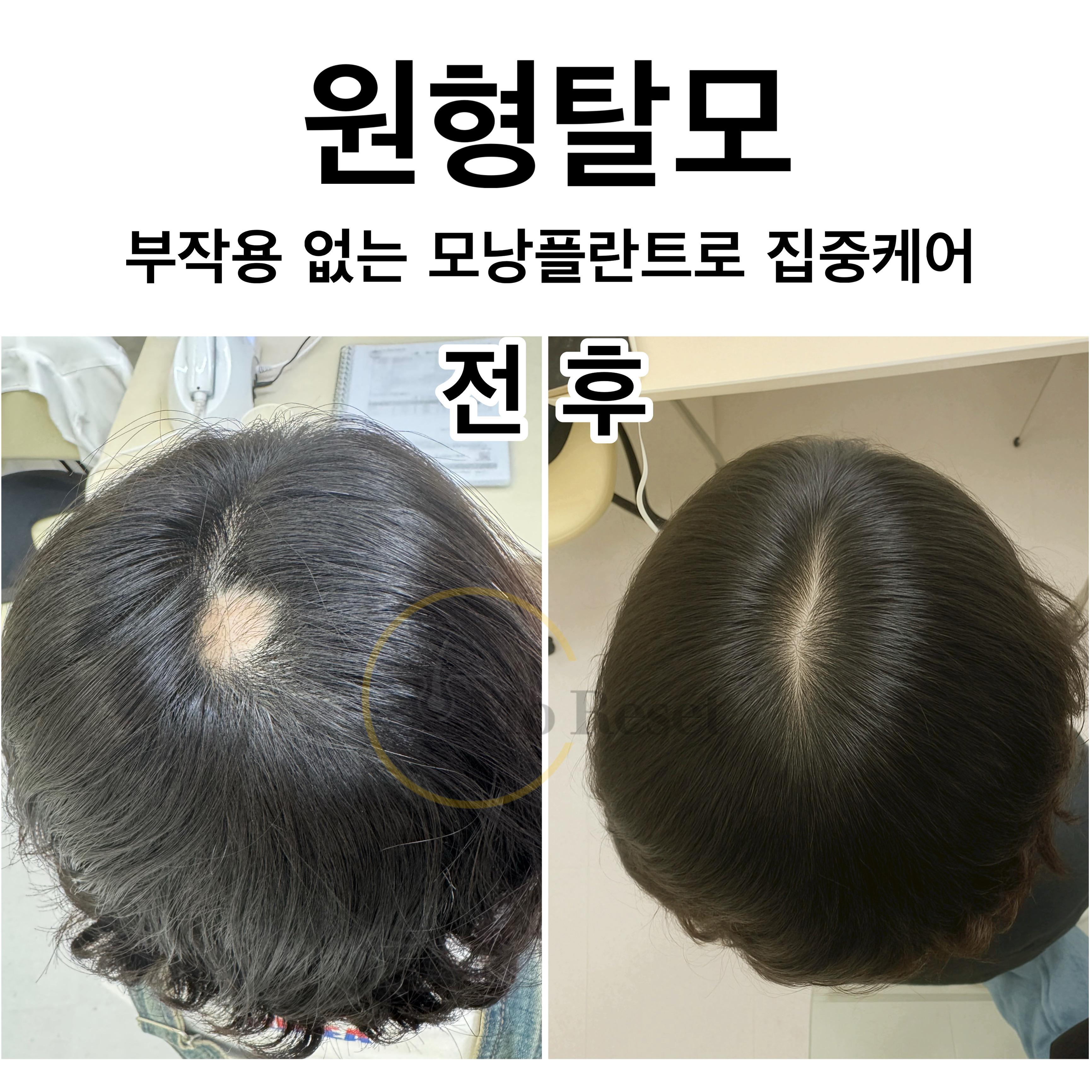 모리셋두피재생센터 창원점 대표 이미지