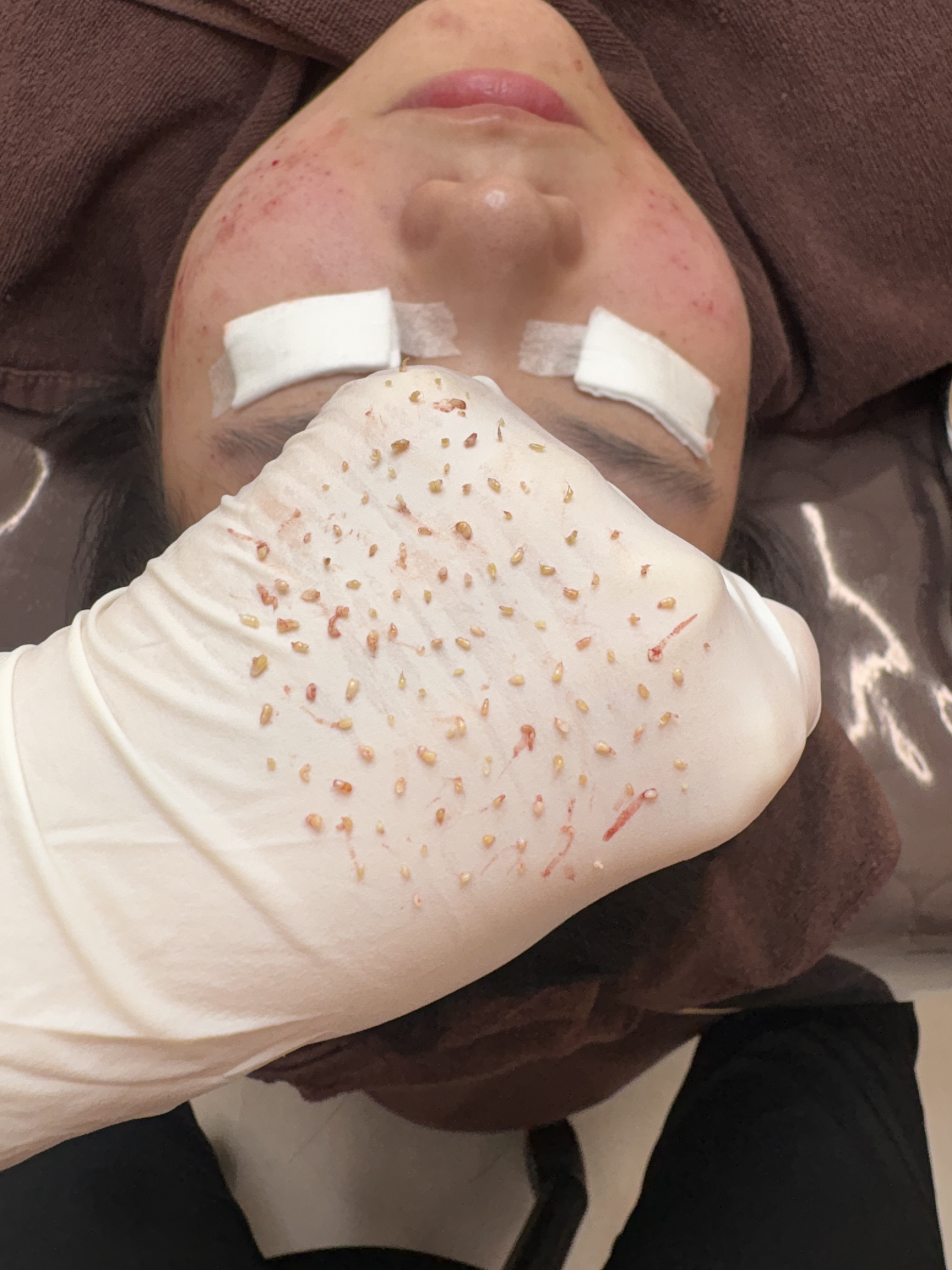 페바아크네룸 대표 이미지