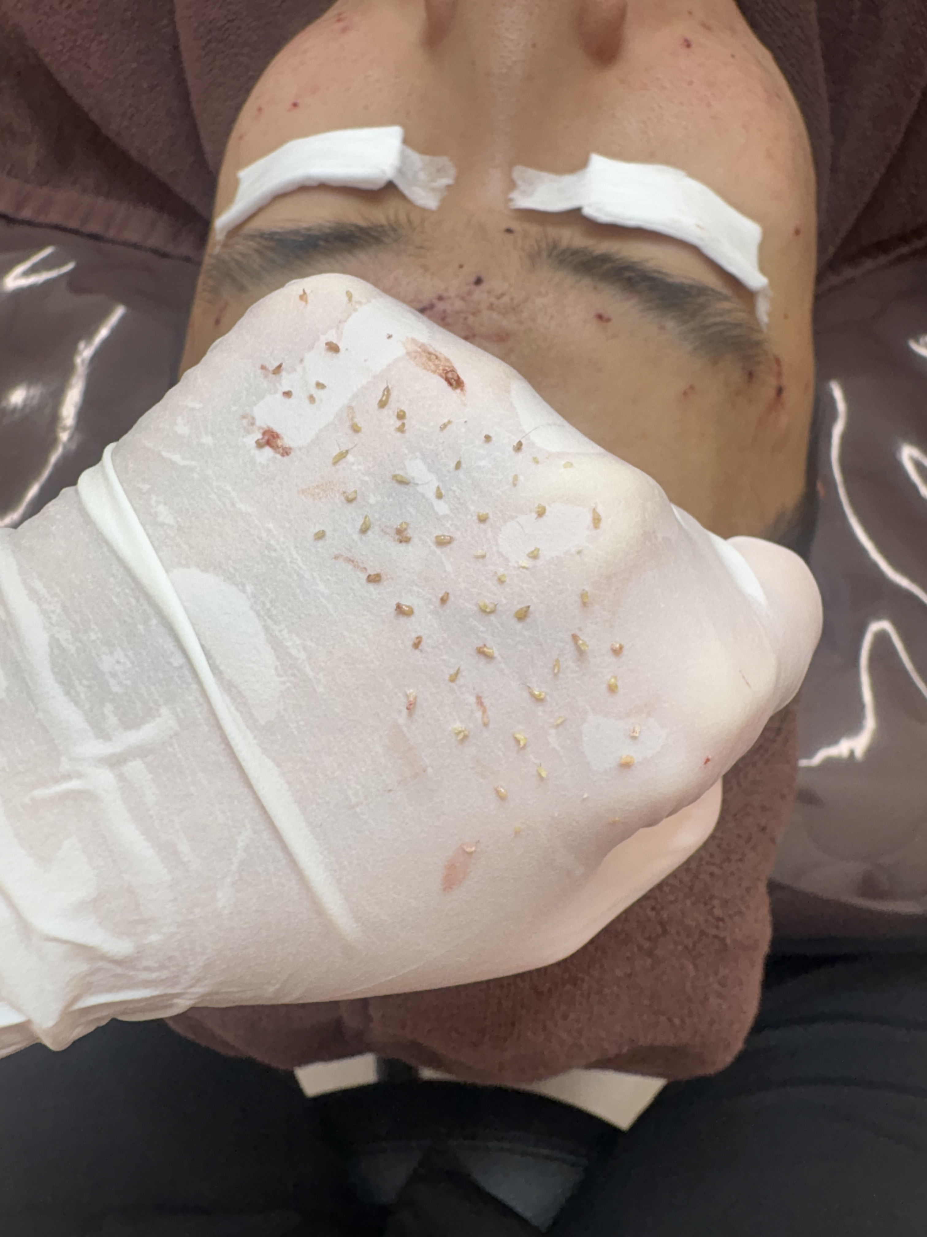 페바아크네룸 대표 이미지