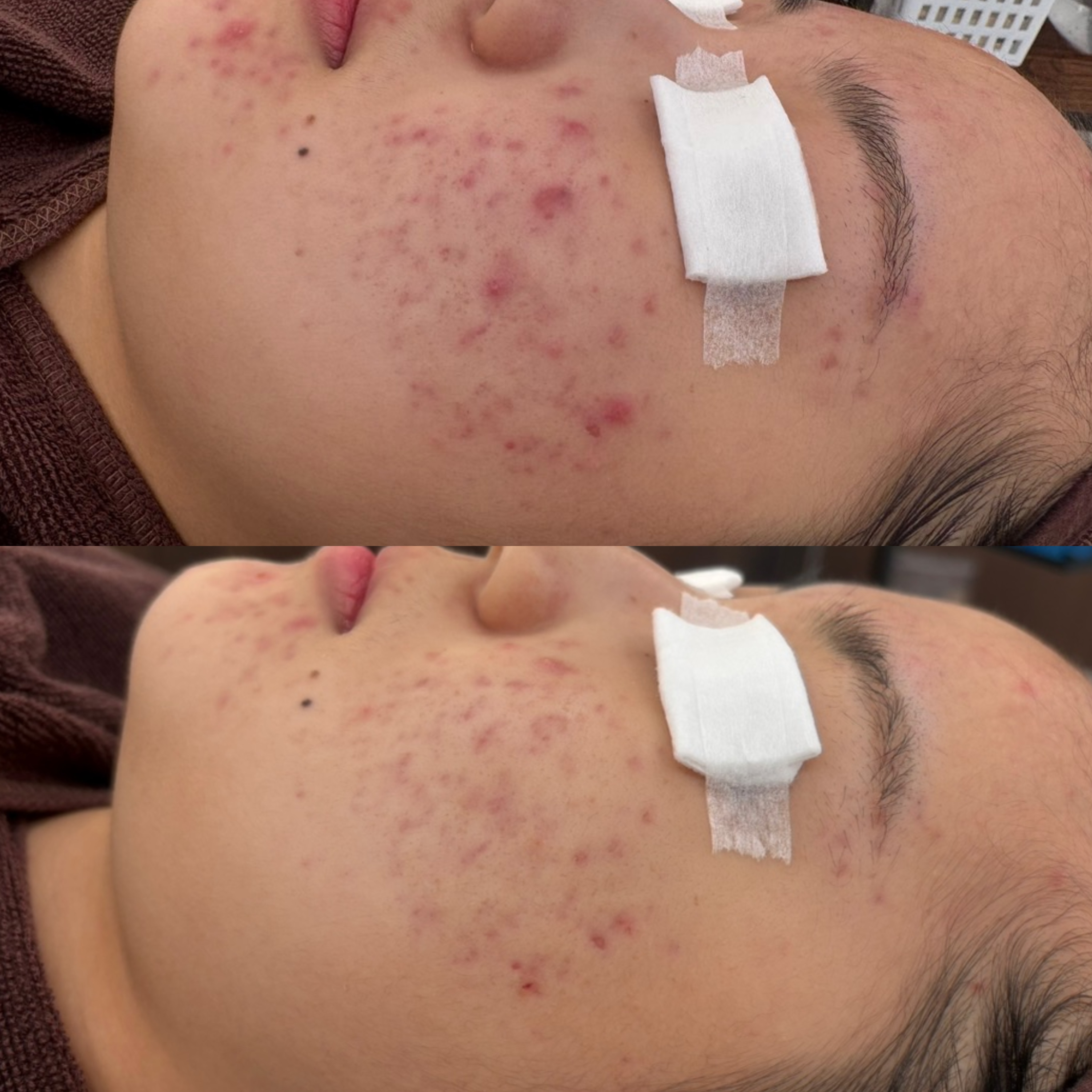 페바아크네룸 대표 이미지