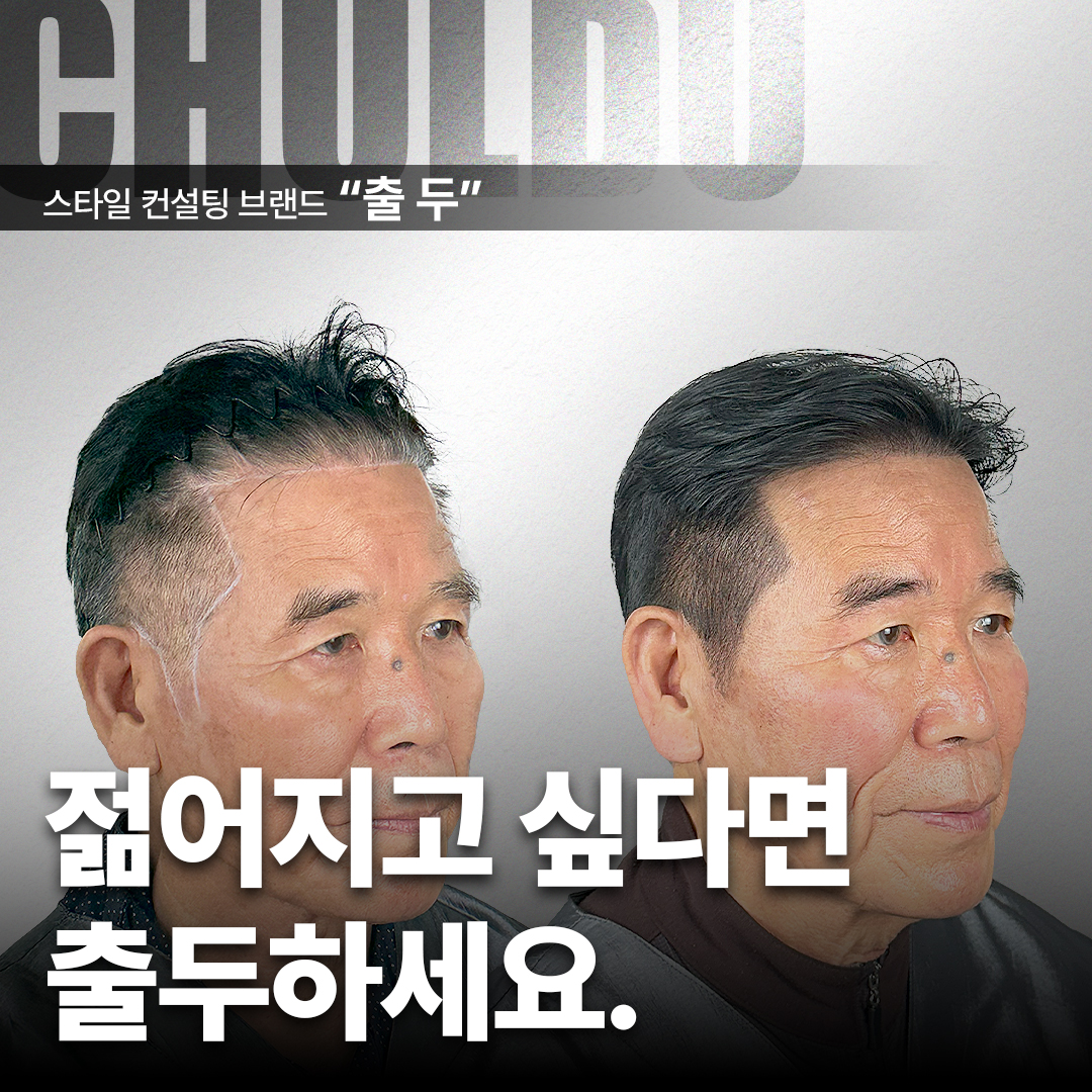 출두SMP 강남본점 대표 이미지 - 두피문신 시술 사진