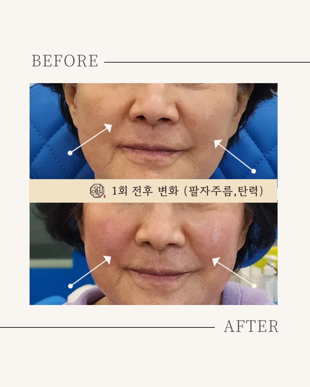 페이스컨디셔닝 광화문 얼굴윤곽 팔자주름 신부관리 photo 10