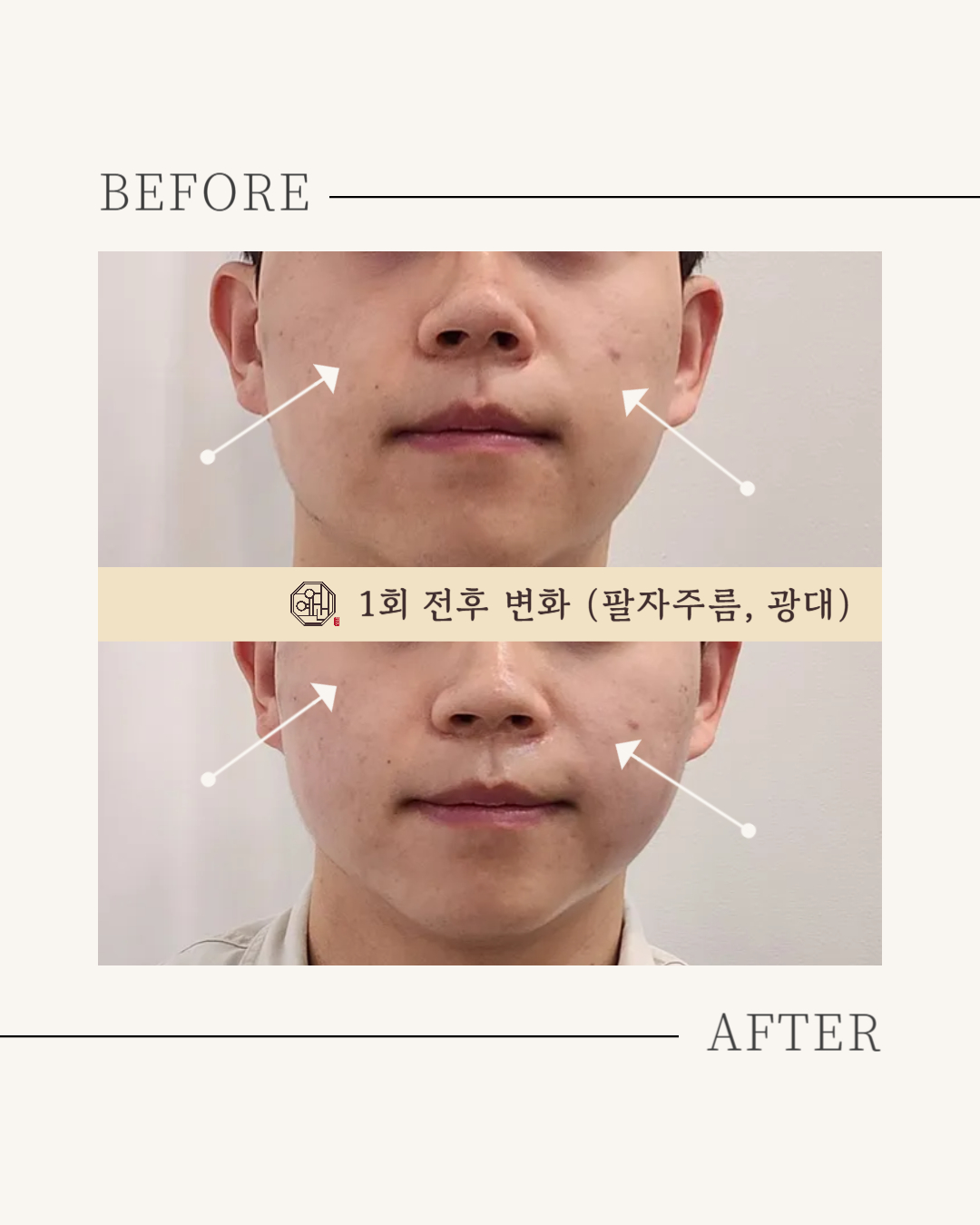 페이스컨디셔닝 광화문 얼굴윤곽 팔자주름 신부관리 photo 9