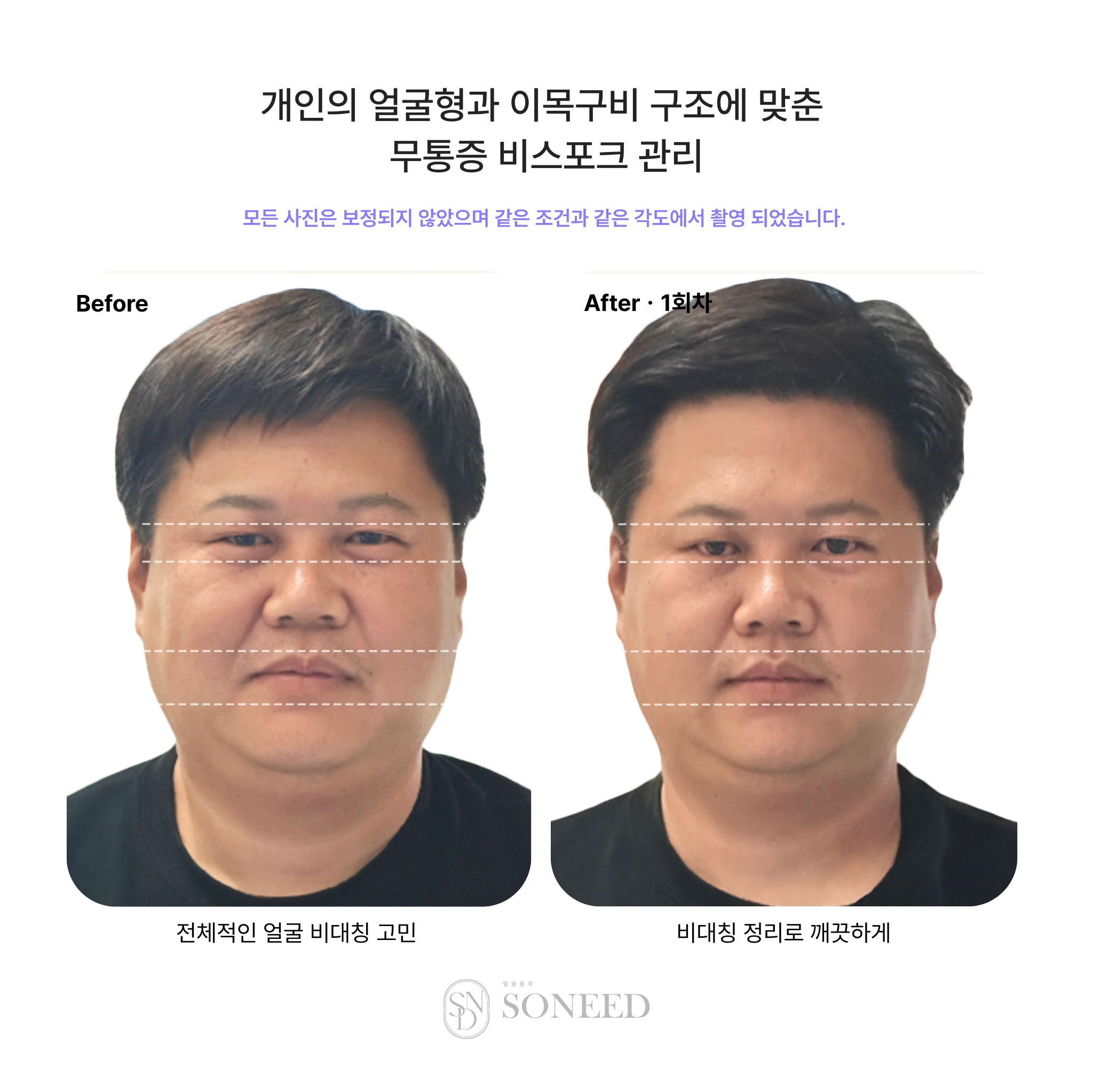소니드 얼굴윤곽 대치도곡점 대표 이미지