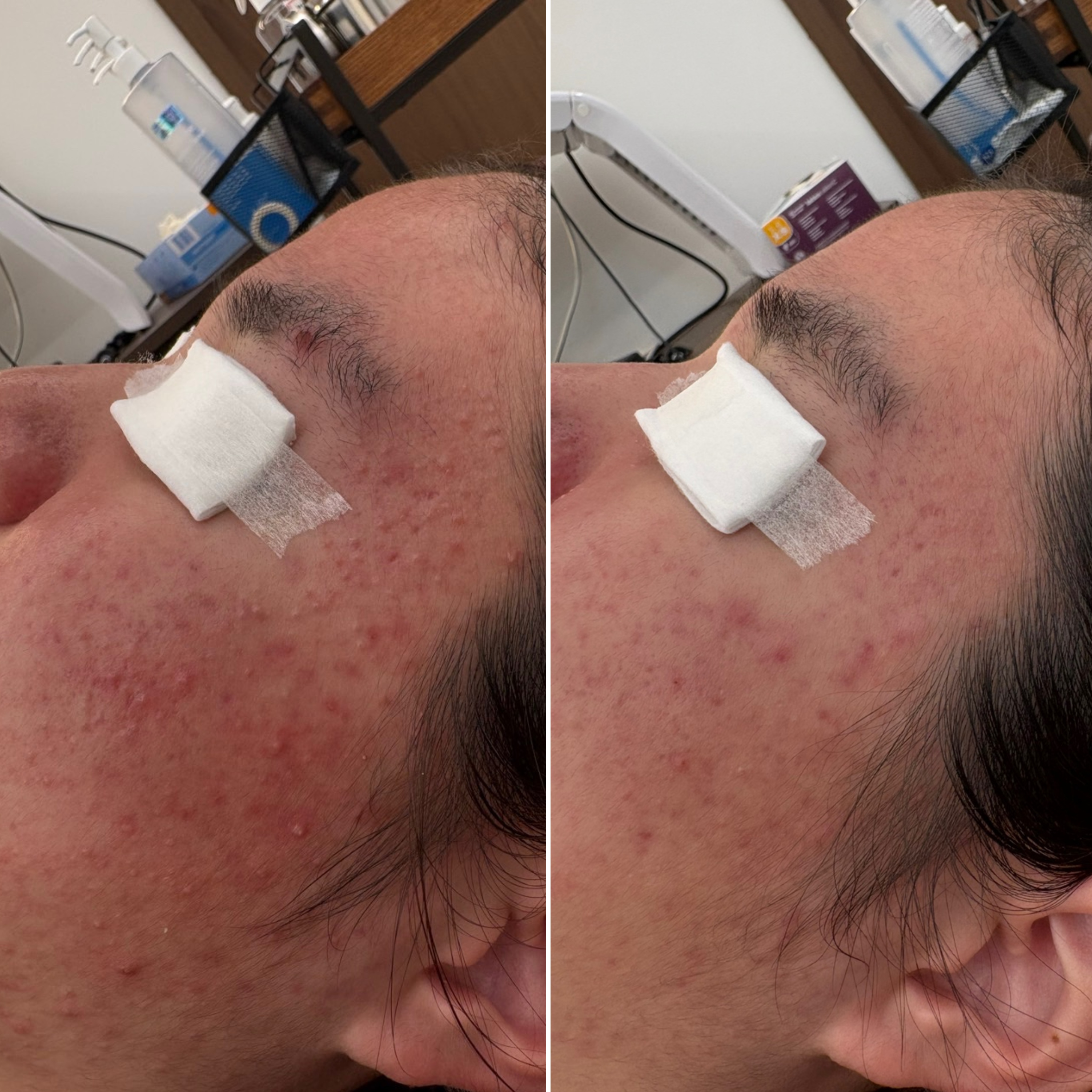 페바아크네룸 대표 이미지