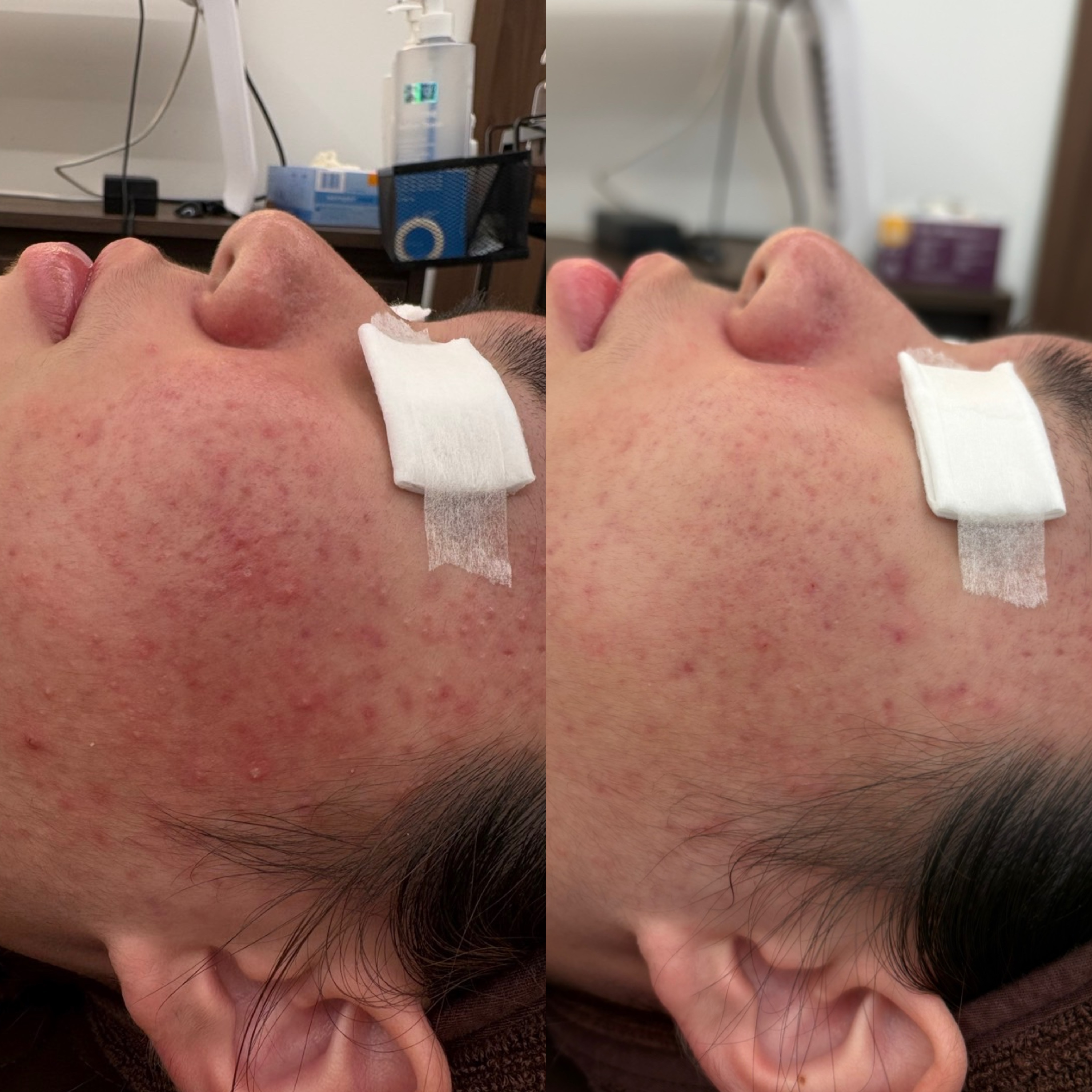 페바아크네룸 대표 이미지