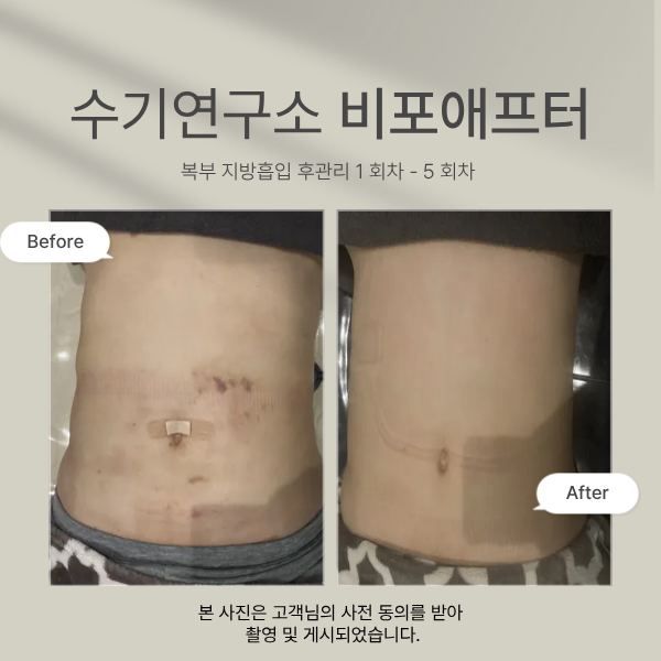 지방흡입 후관리 수기연구소 대표 이미지