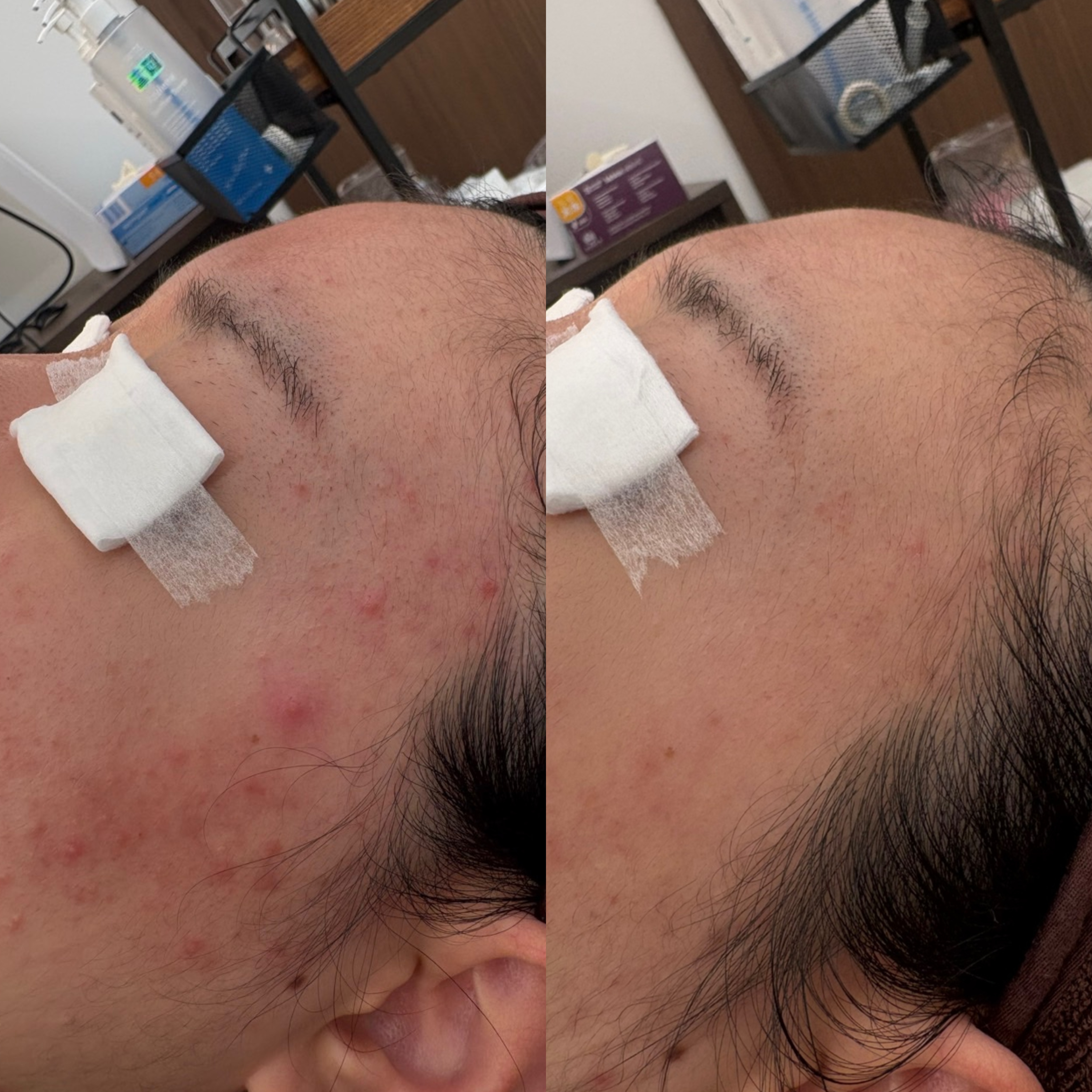 페바아크네룸 대표 이미지