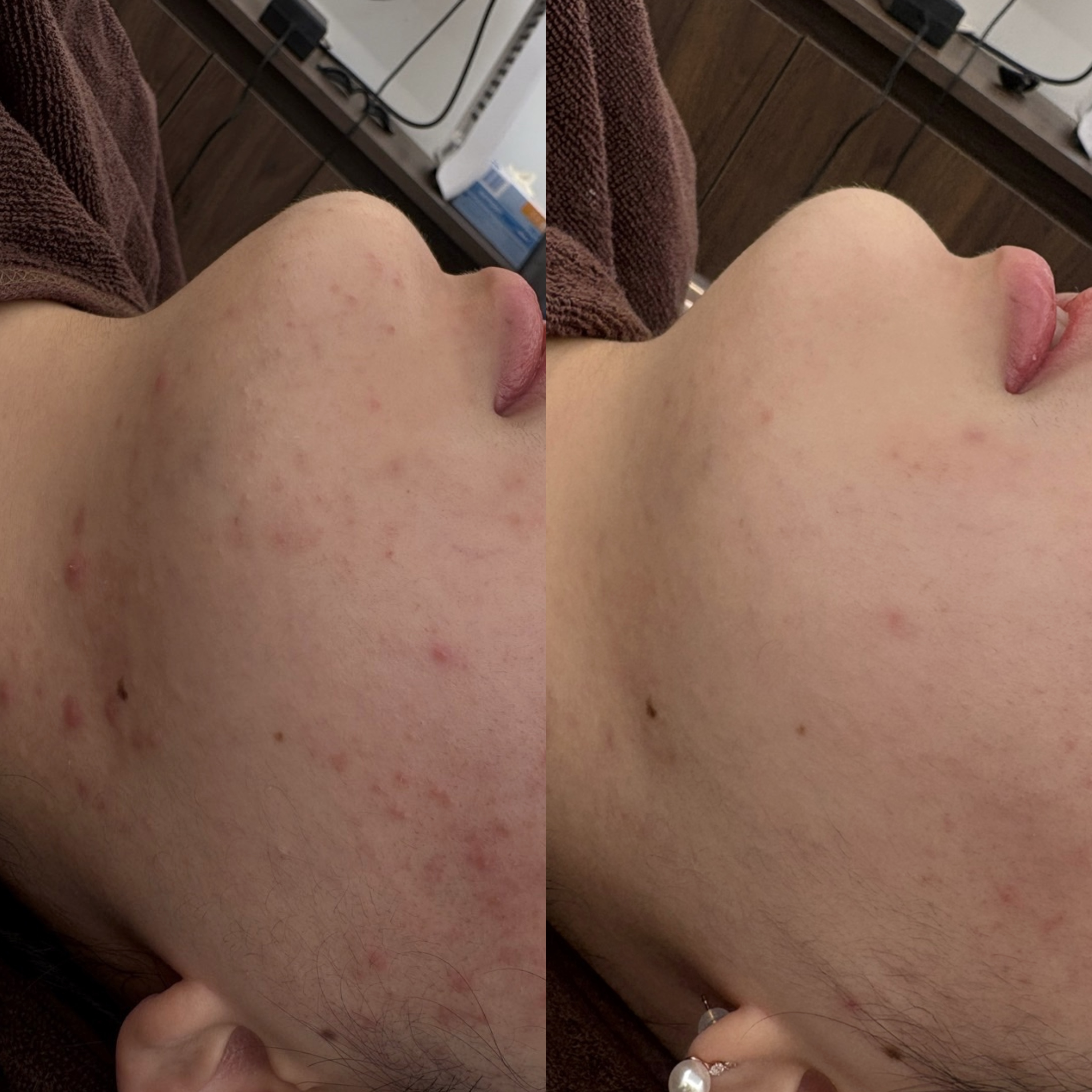 페바아크네룸 대표 이미지