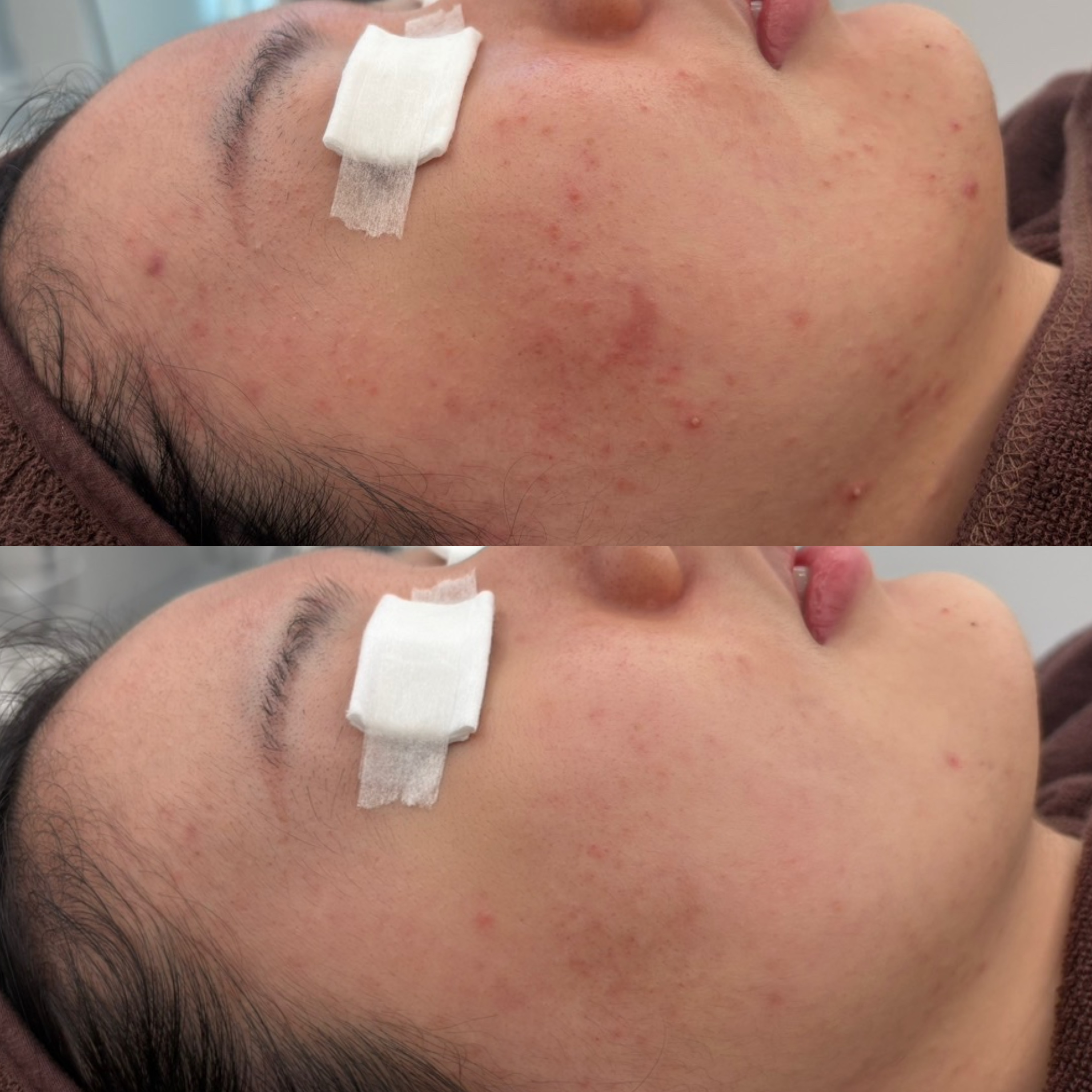 페바아크네룸 대표 이미지