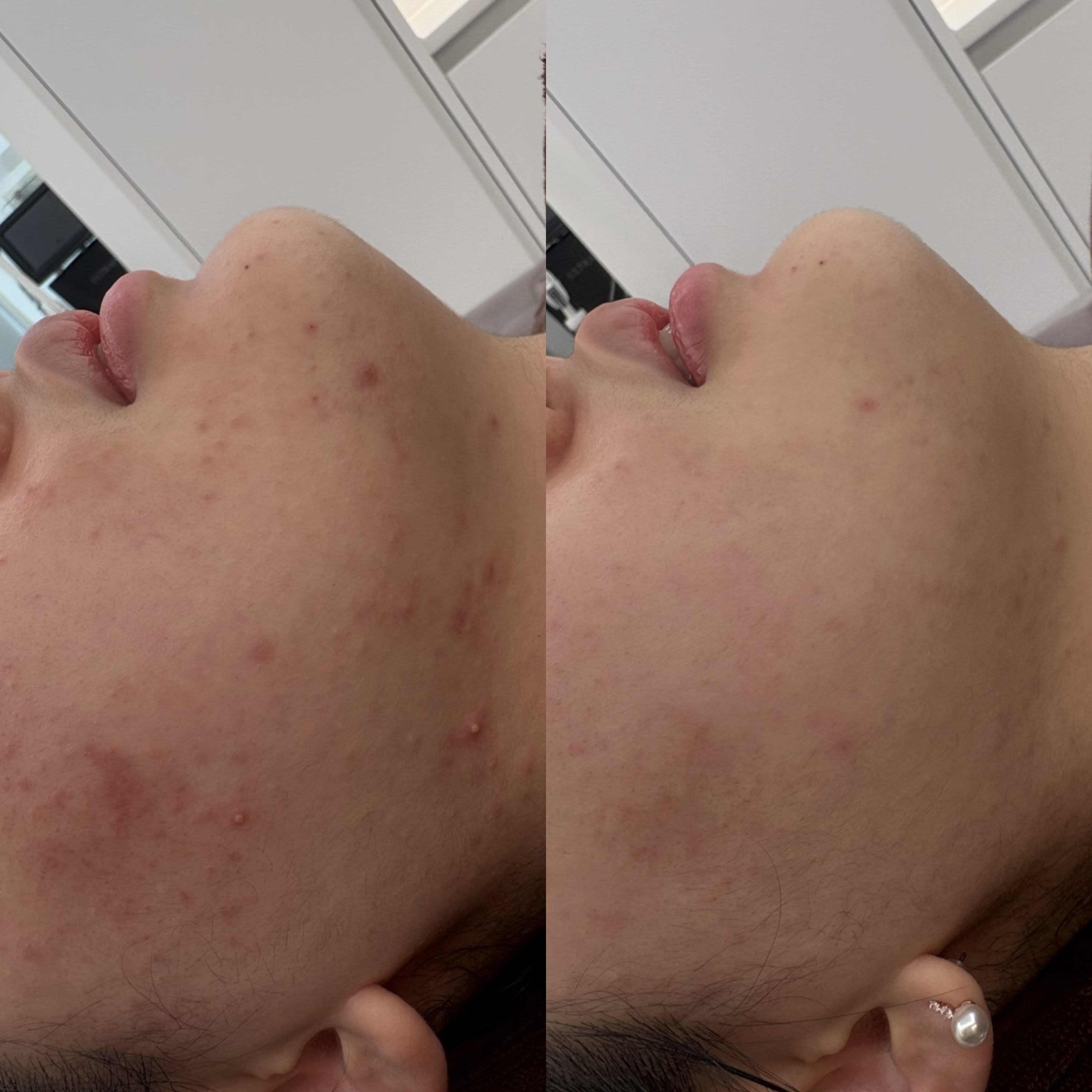 페바아크네룸 대표 이미지