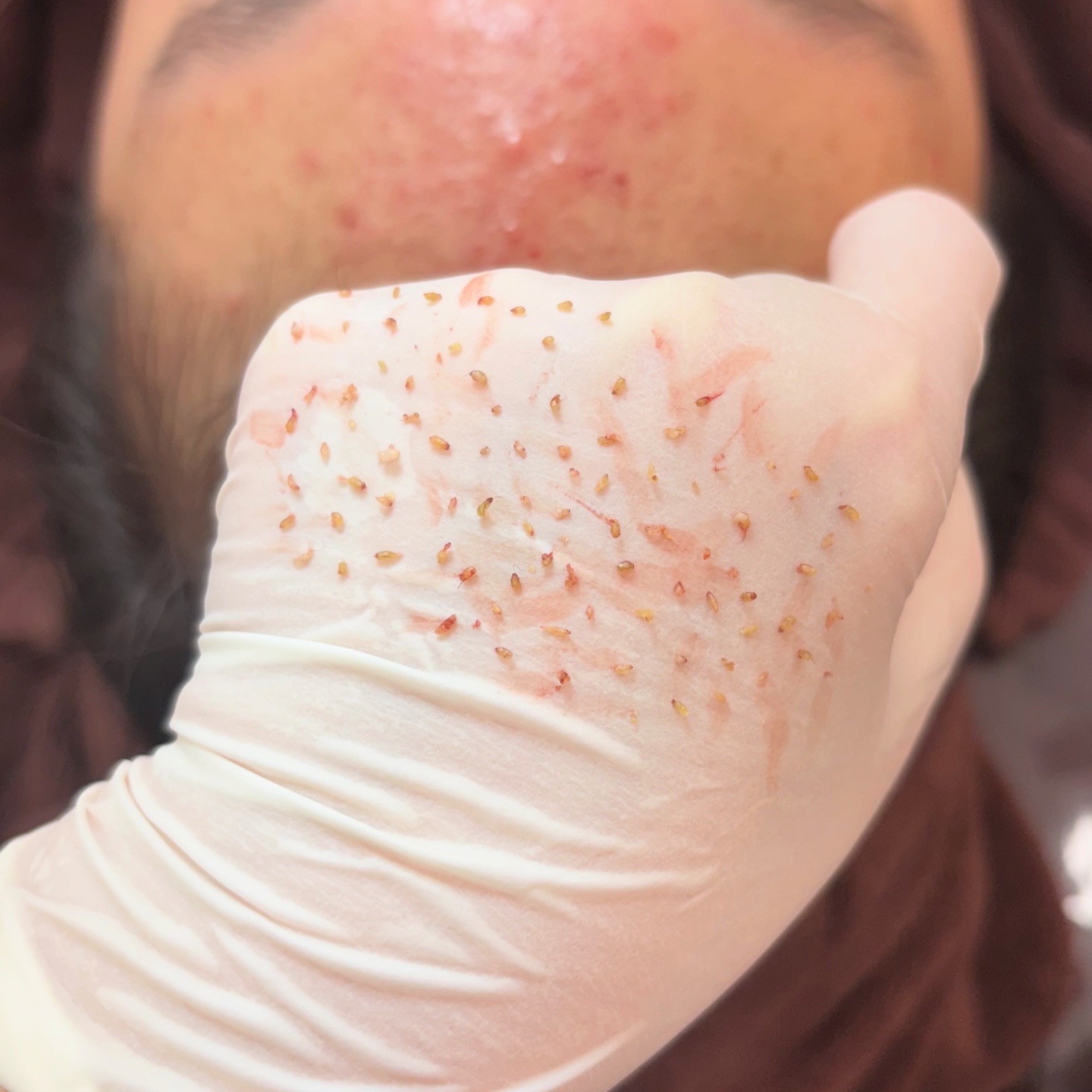 페바아크네룸 대표 이미지