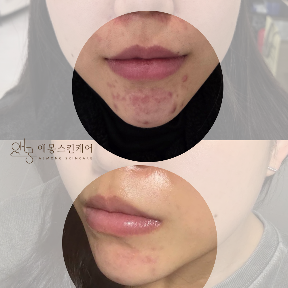 애몽스킨케어 대표 이미지