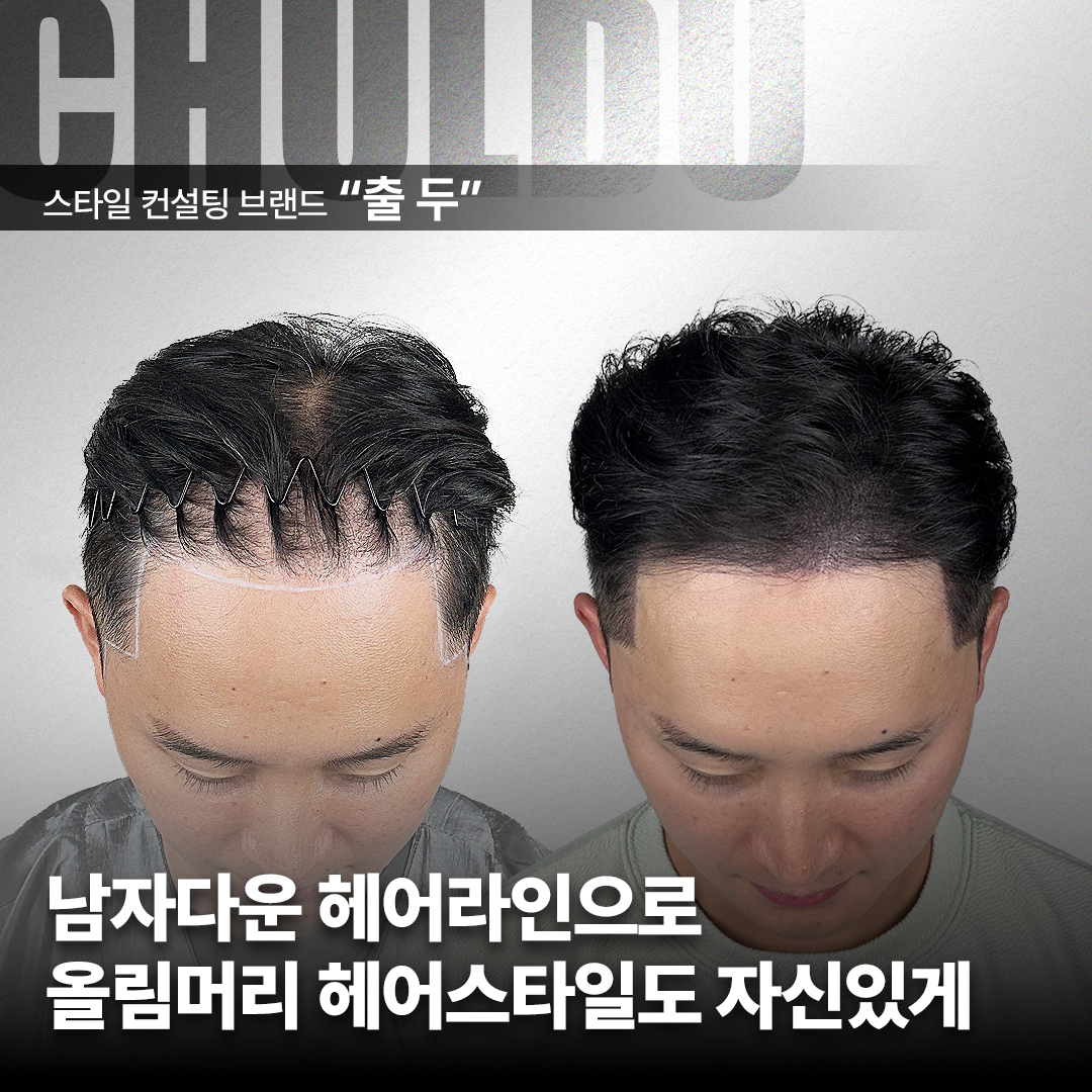 출두SMP 강남본점 대표 이미지 - 두피문신 전후 사진