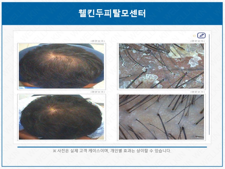 웰킨두피탈모센터 대표 이미지