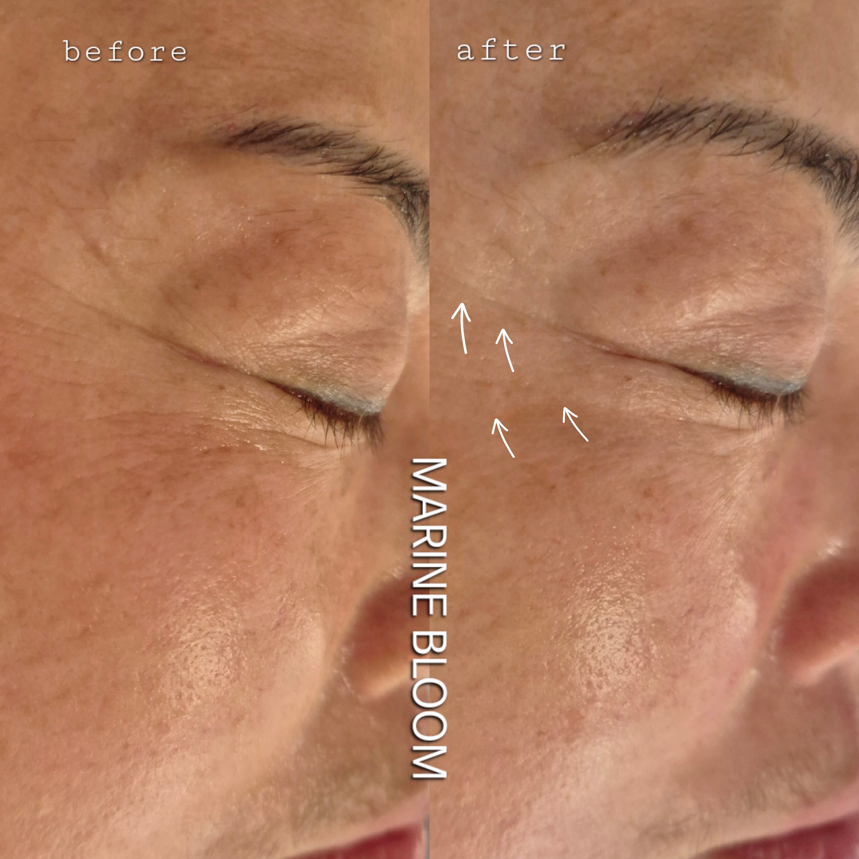 고원장 모공세척 대표 이미지