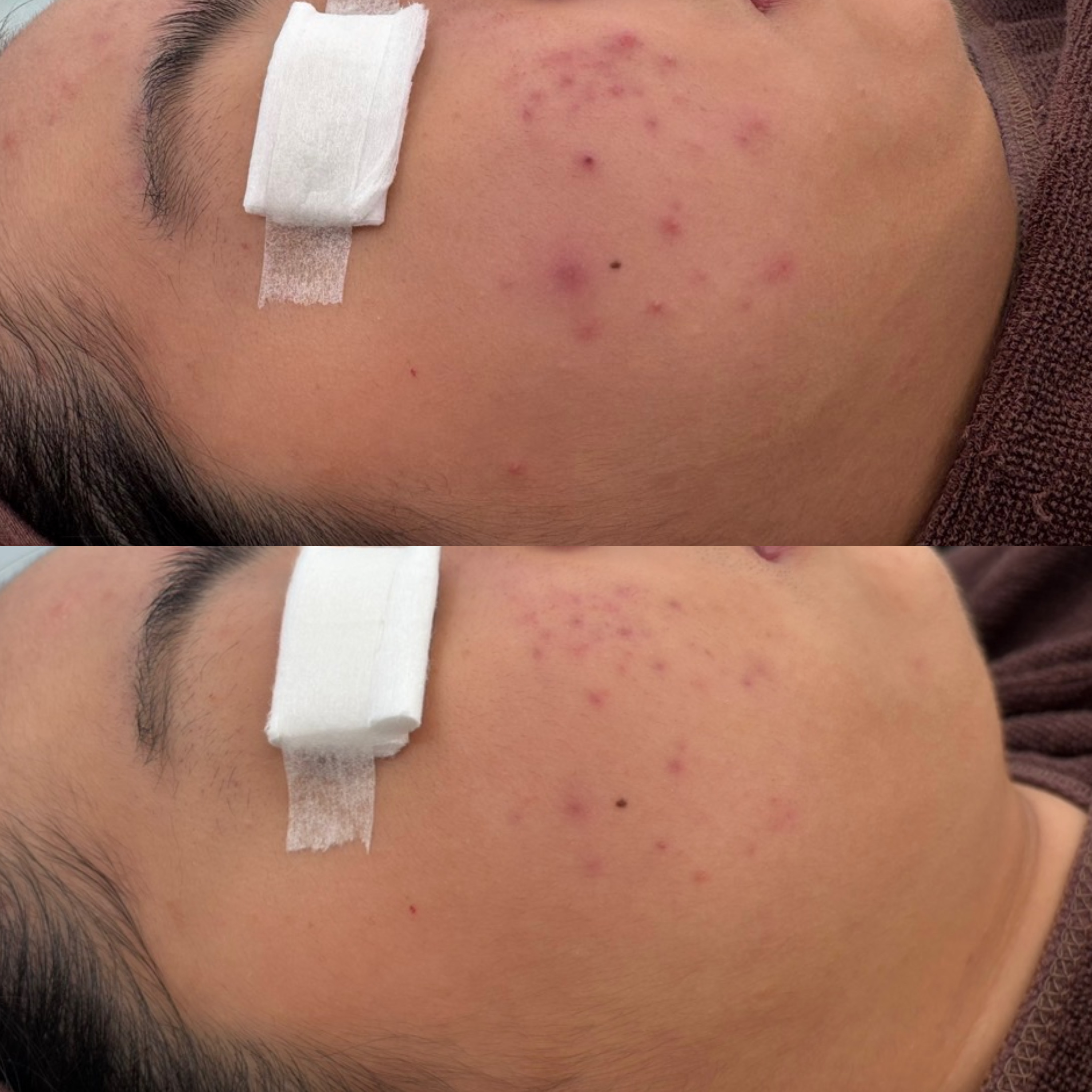 페바아크네룸 대표 이미지