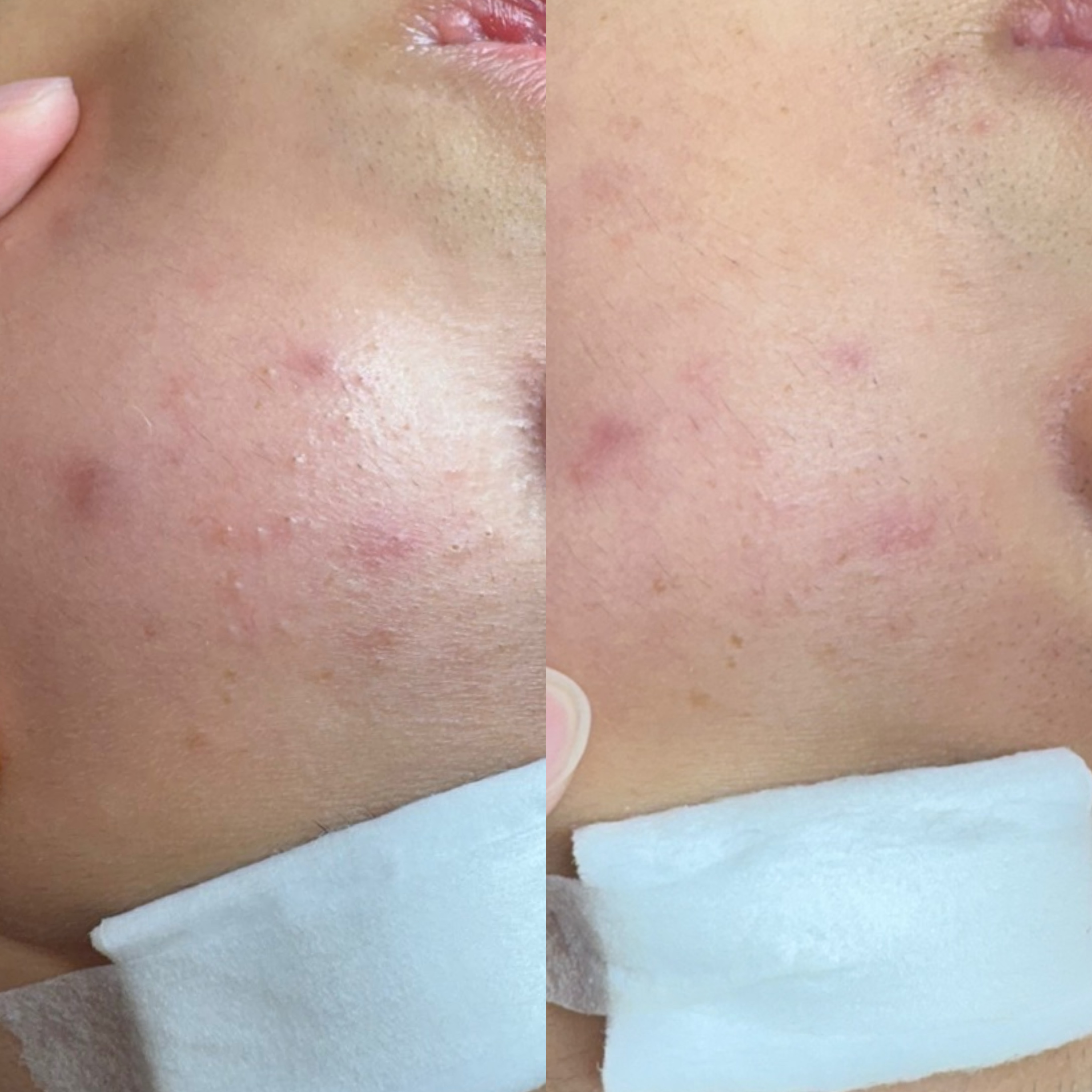 페바아크네룸 대표 이미지