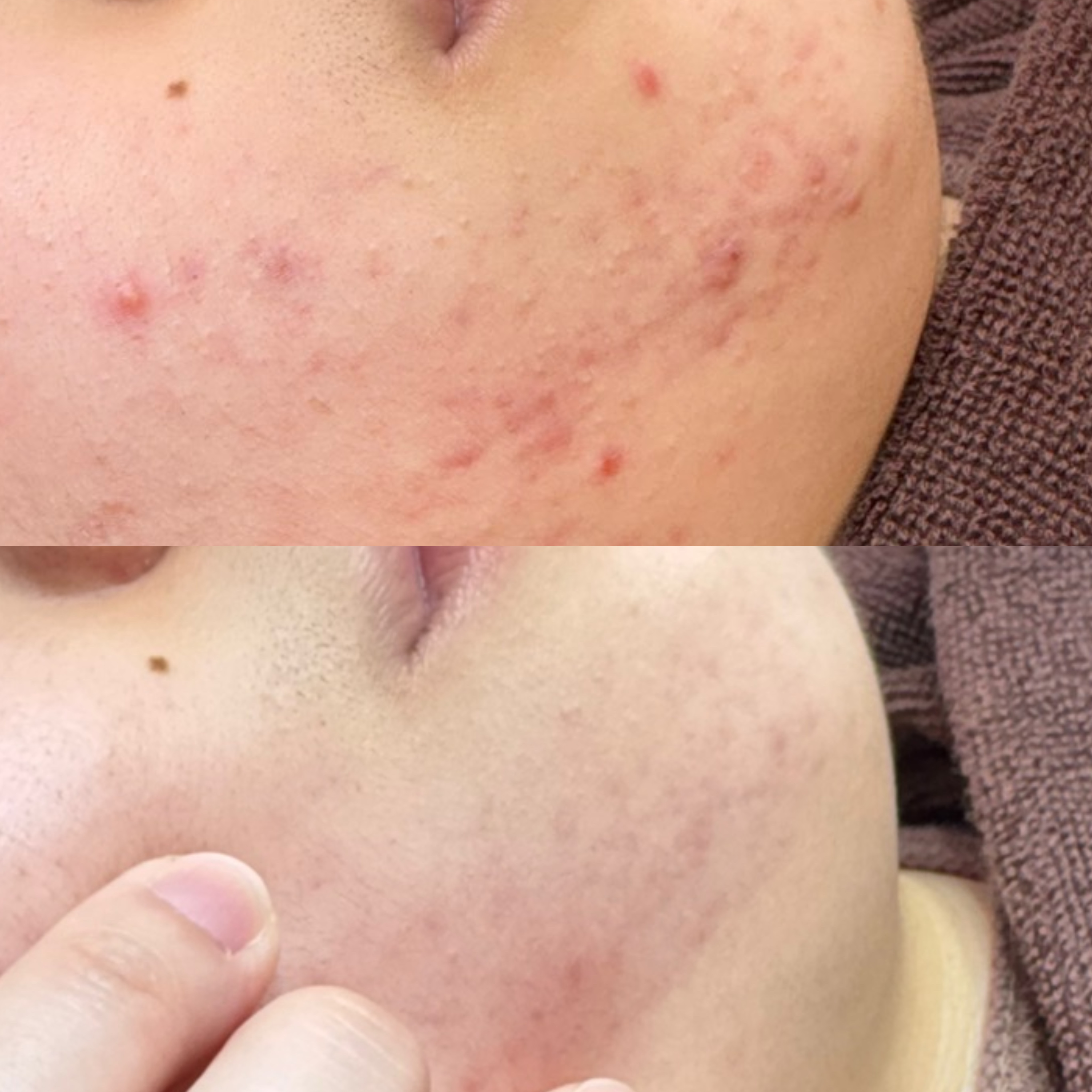 페바아크네룸 대표 이미지