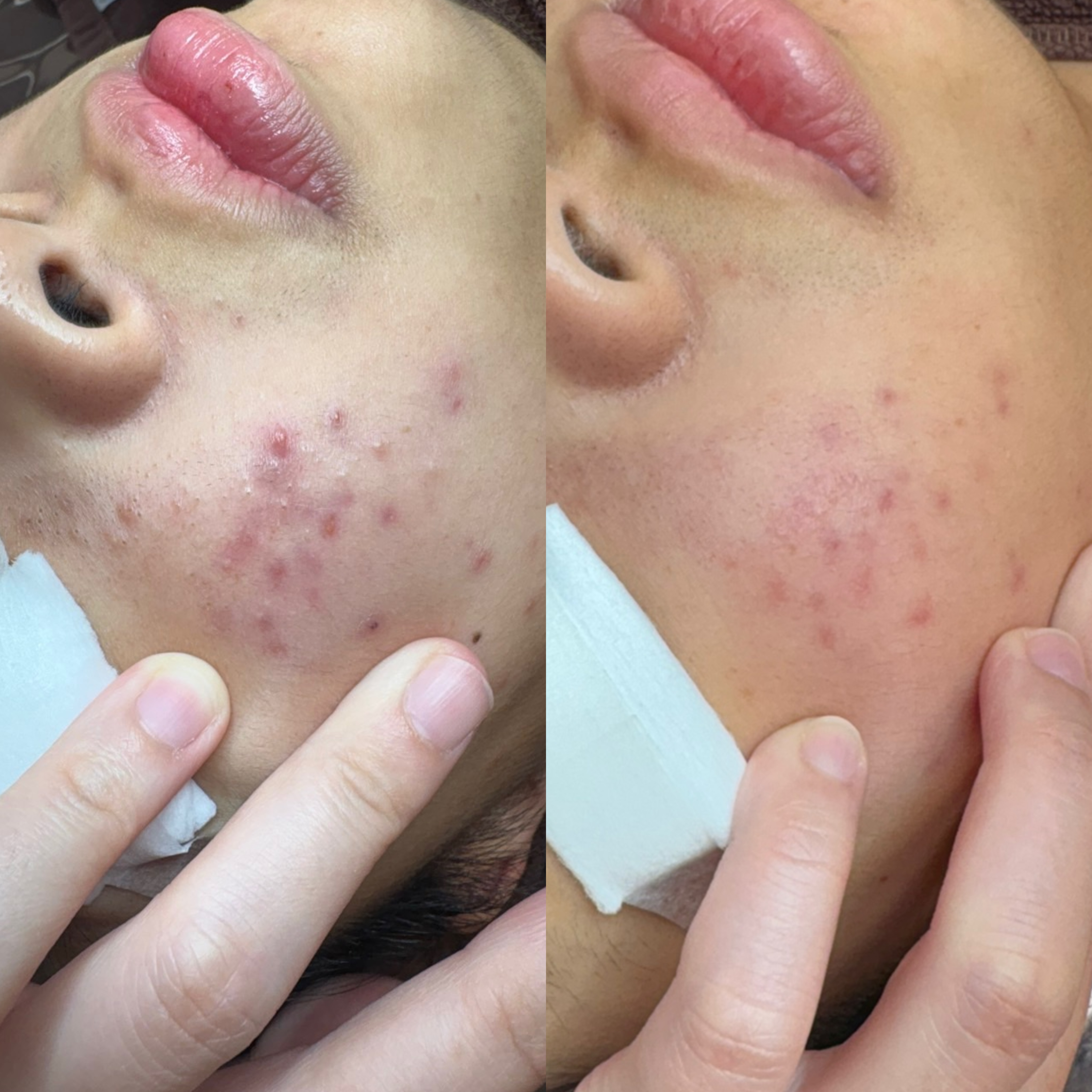 페바아크네룸 대표 이미지