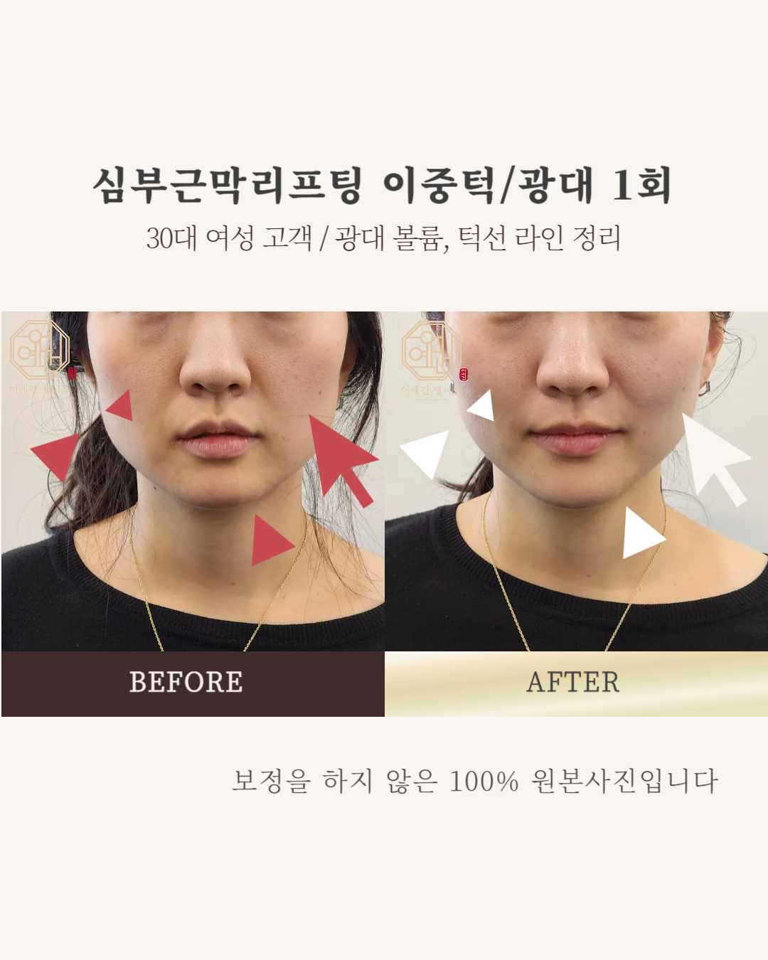 페이스컨디셔닝 광화문 얼굴윤곽 팔자주름 신부관리 photo 4