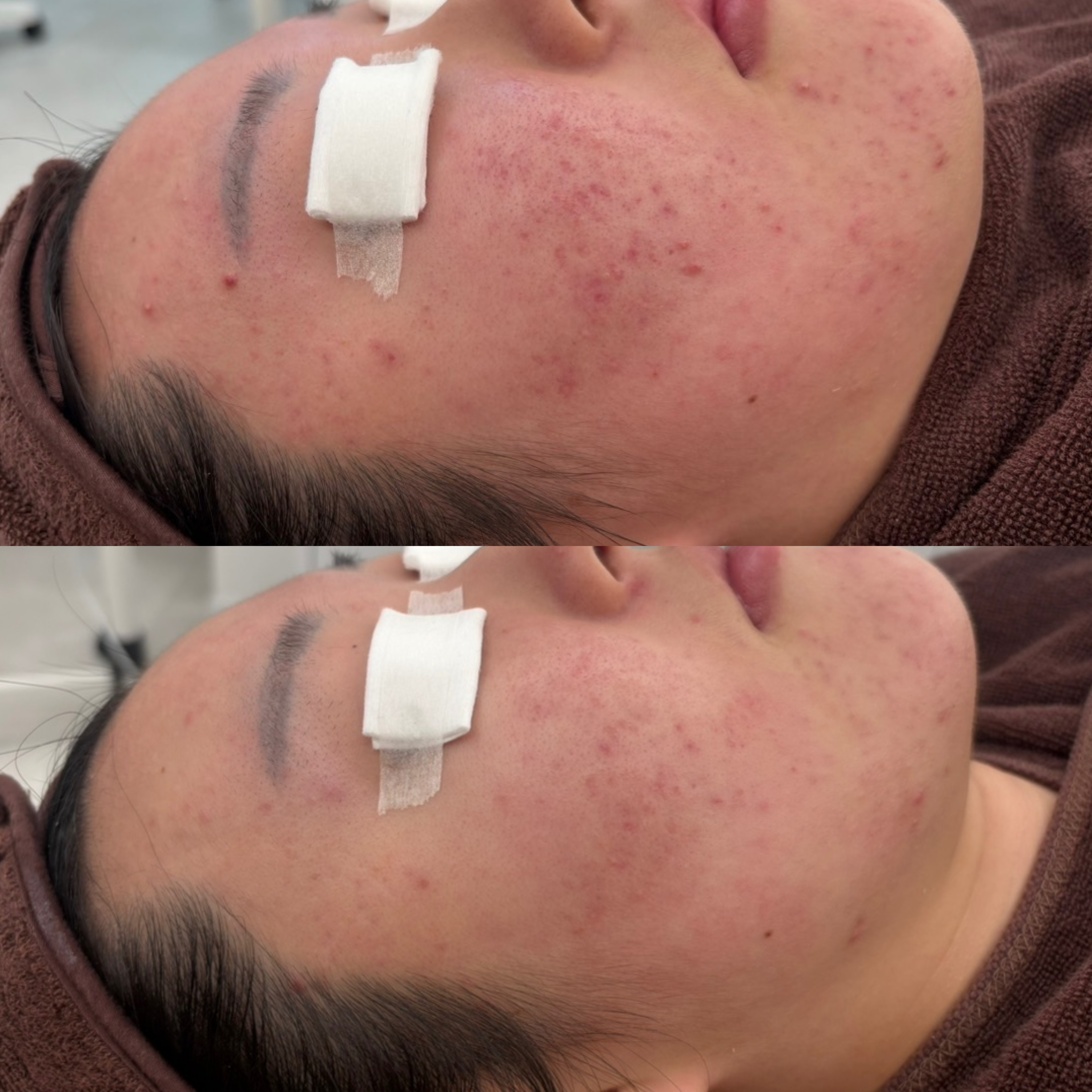 페바아크네룸 대표 이미지