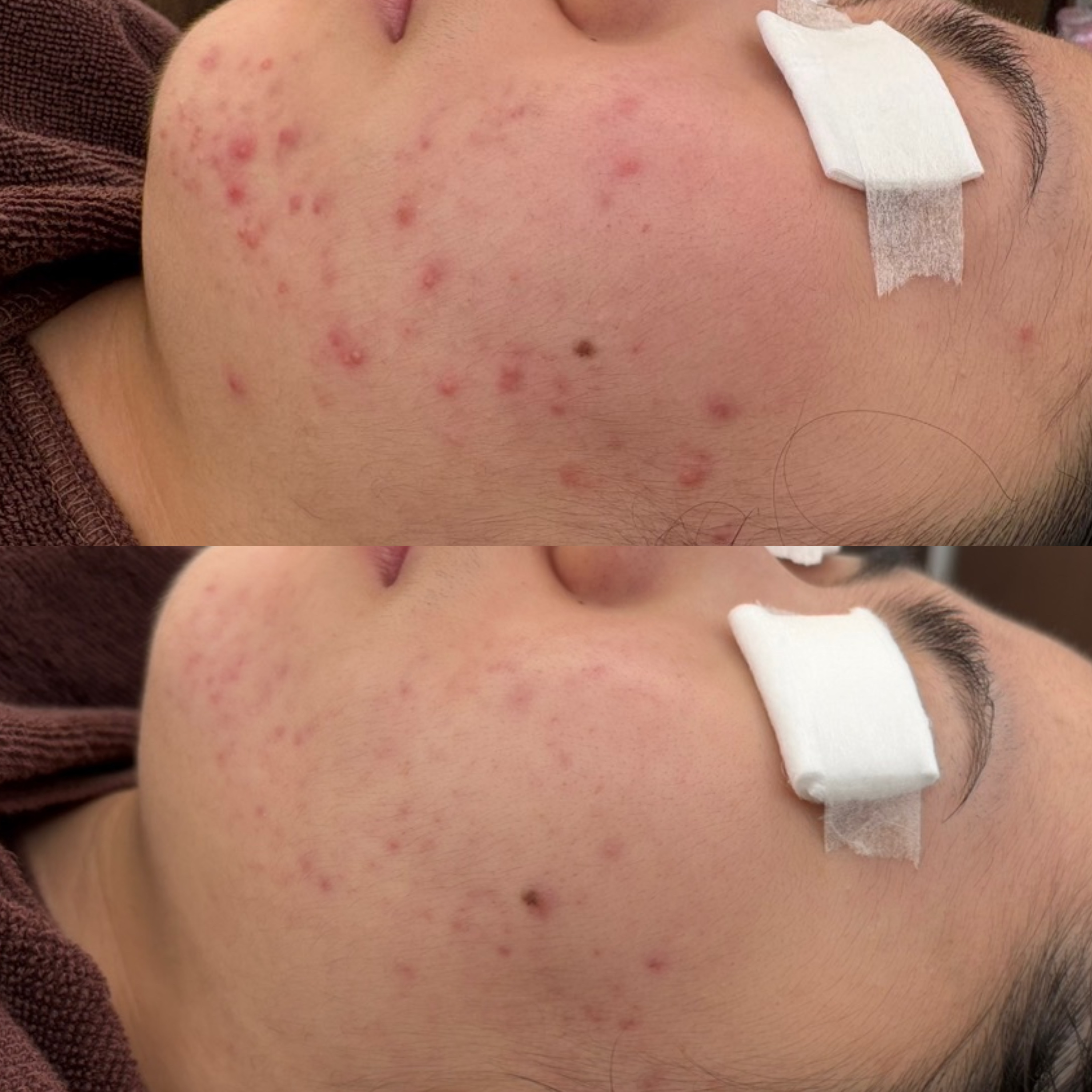 페바아크네룸 대표 이미지