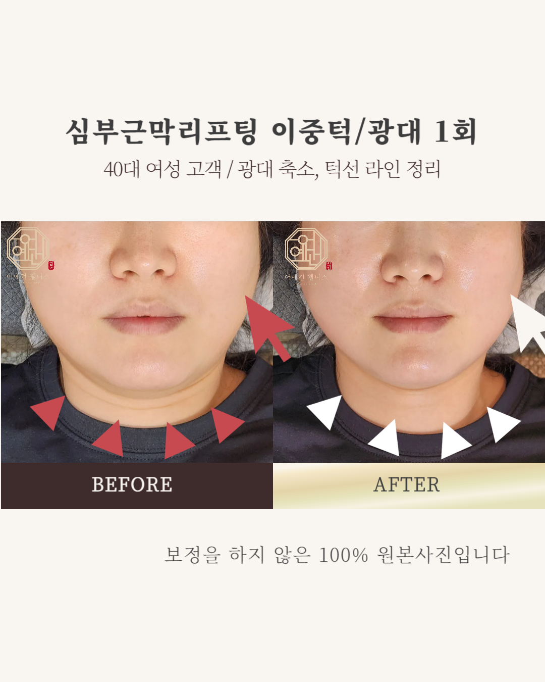 페이스컨디셔닝 광화문 얼굴윤곽 팔자주름 신부관리 photo 3