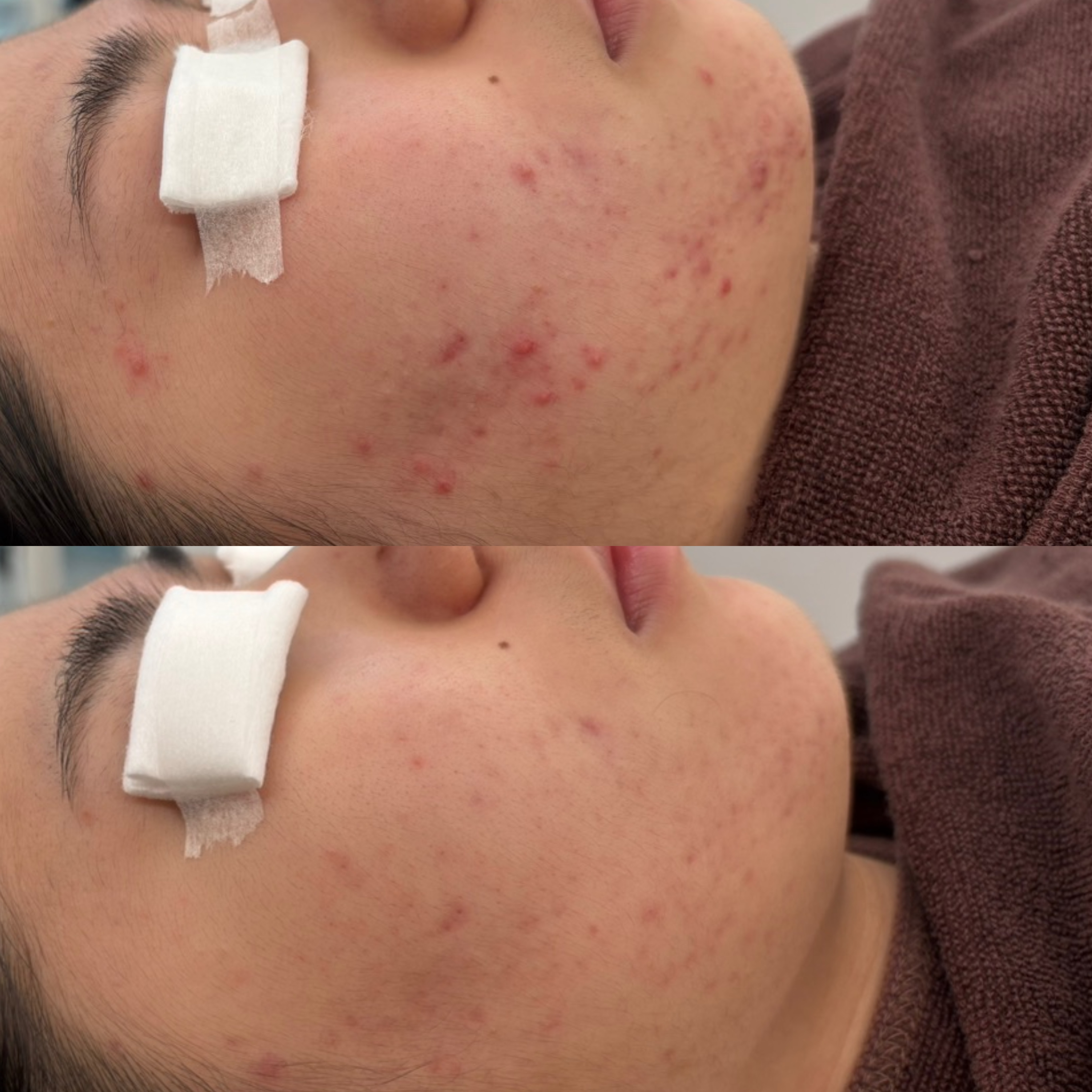 페바아크네룸 대표 이미지