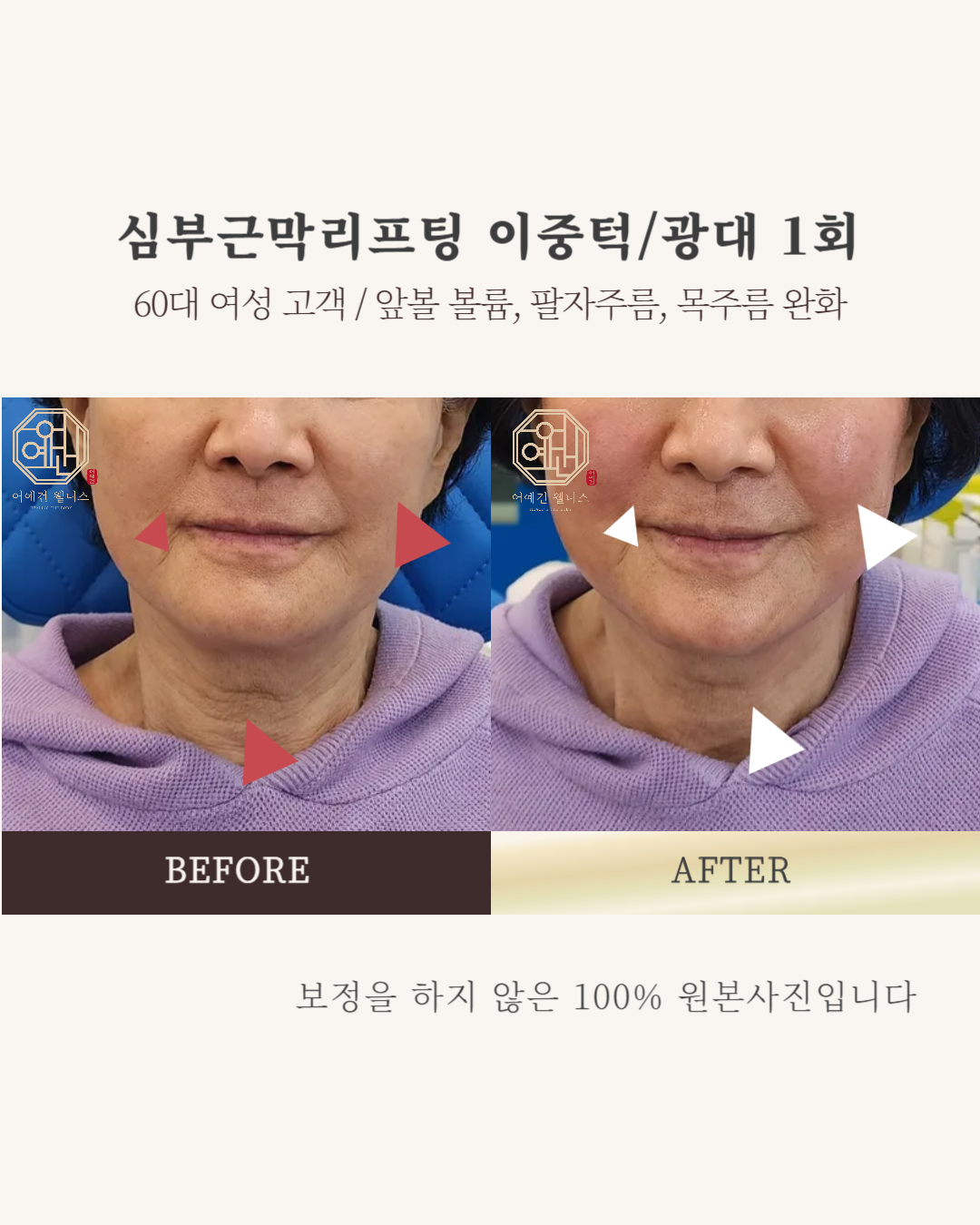 페이스컨디셔닝 광화문 얼굴윤곽 팔자주름 신부관리 photo 7