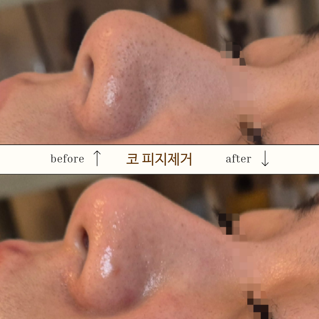 고원장의모공세척테라피 대표 이미지