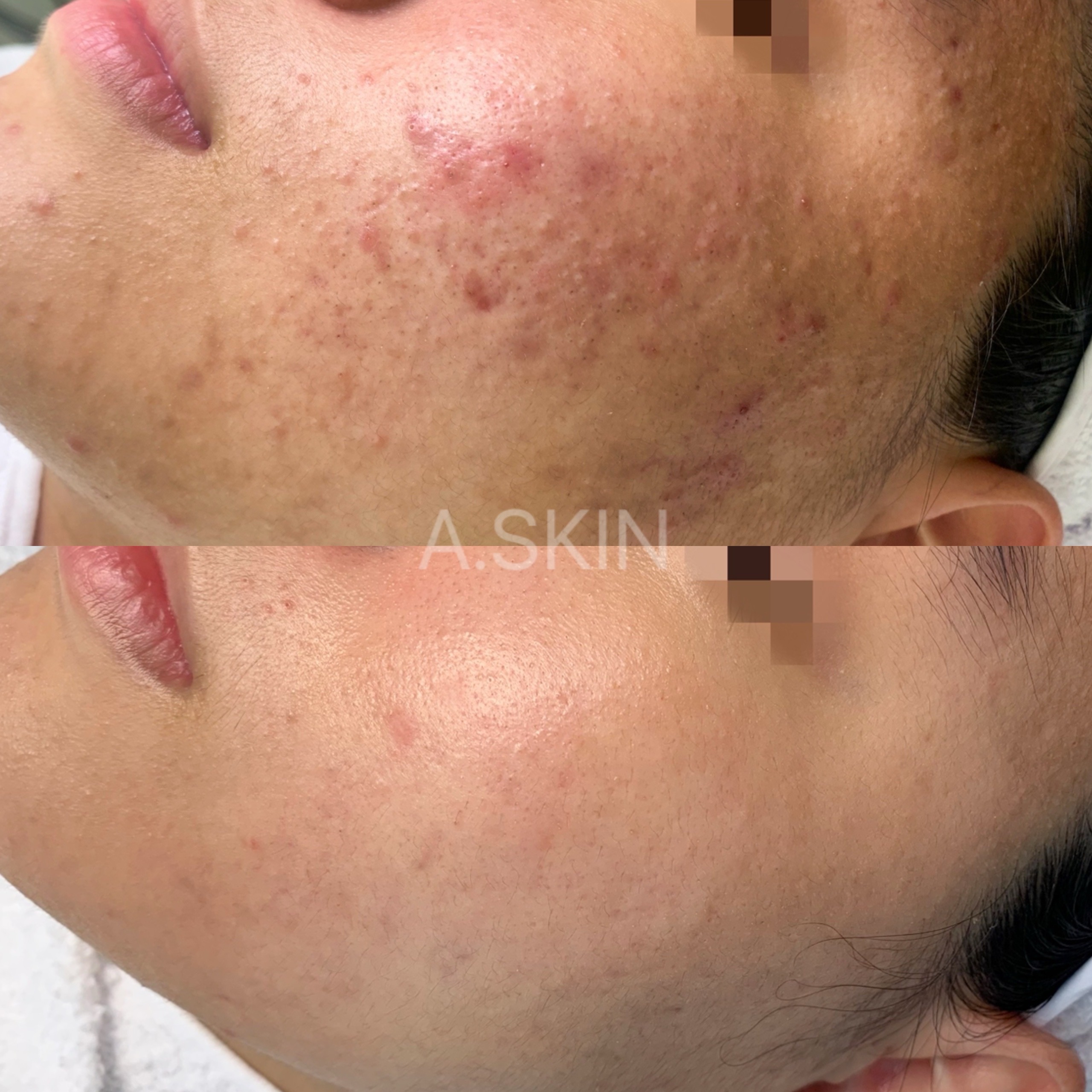 에이스킨 대표 이미지