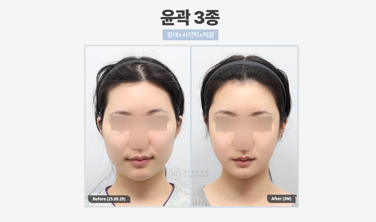 비티성형외과 대표 이미지