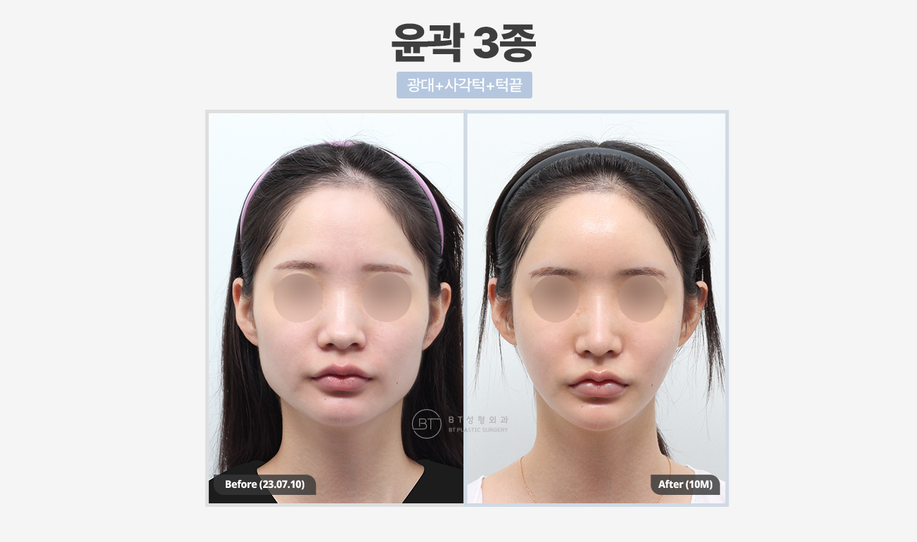 비티성형외과 대표 이미지