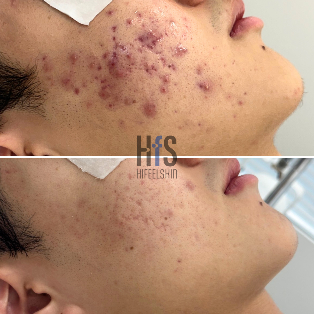 하이필스킨 대표 이미지