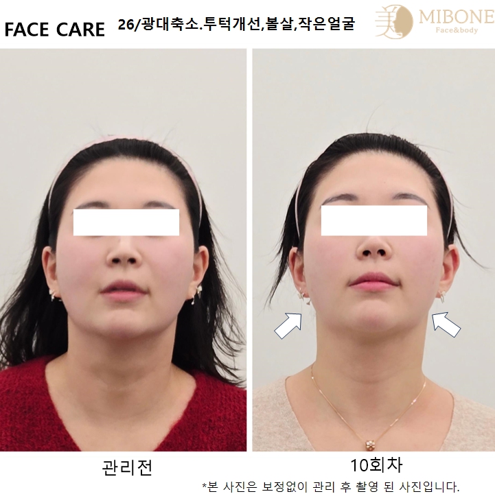 미본 얼굴윤곽관리 대표 이미지
