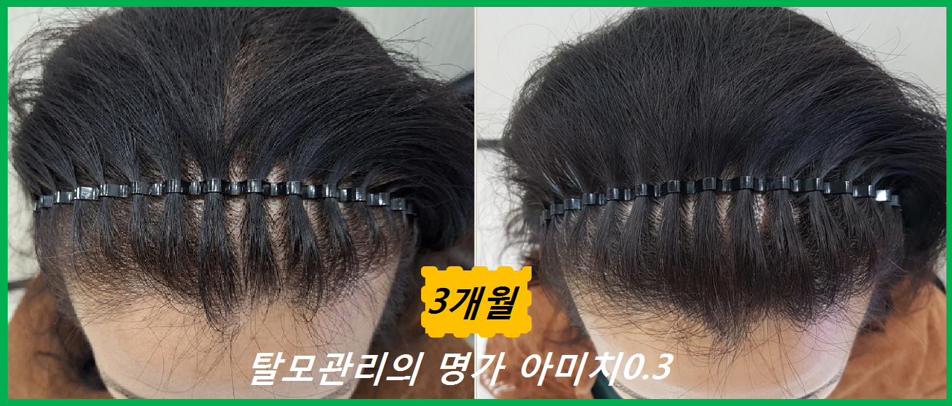 탈모 아미치 0.3 공덕점 대표 이미지