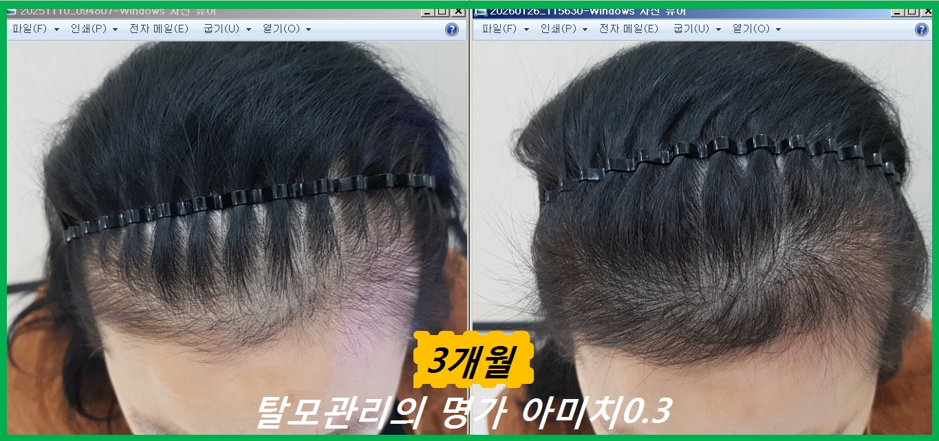 탈모 아미치 0.3 공덕점 대표 이미지