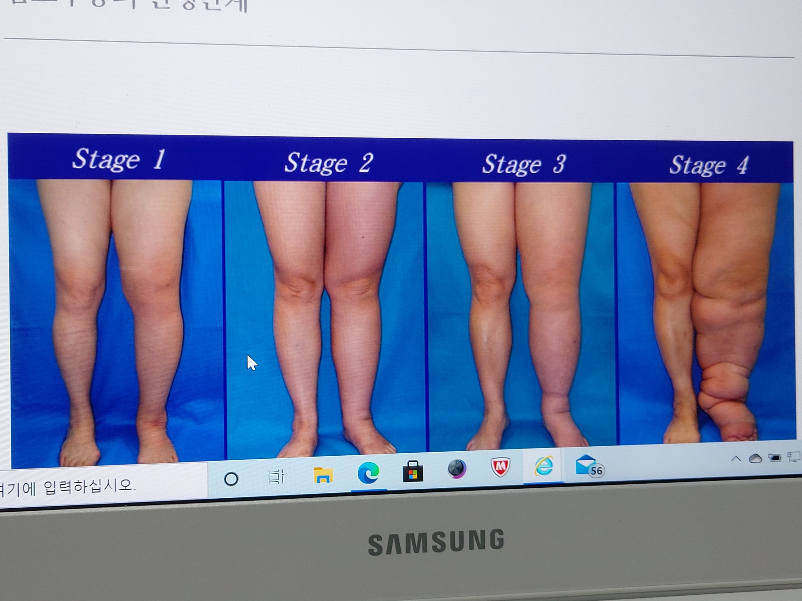 임채강 림프드레나쥐 photo 9