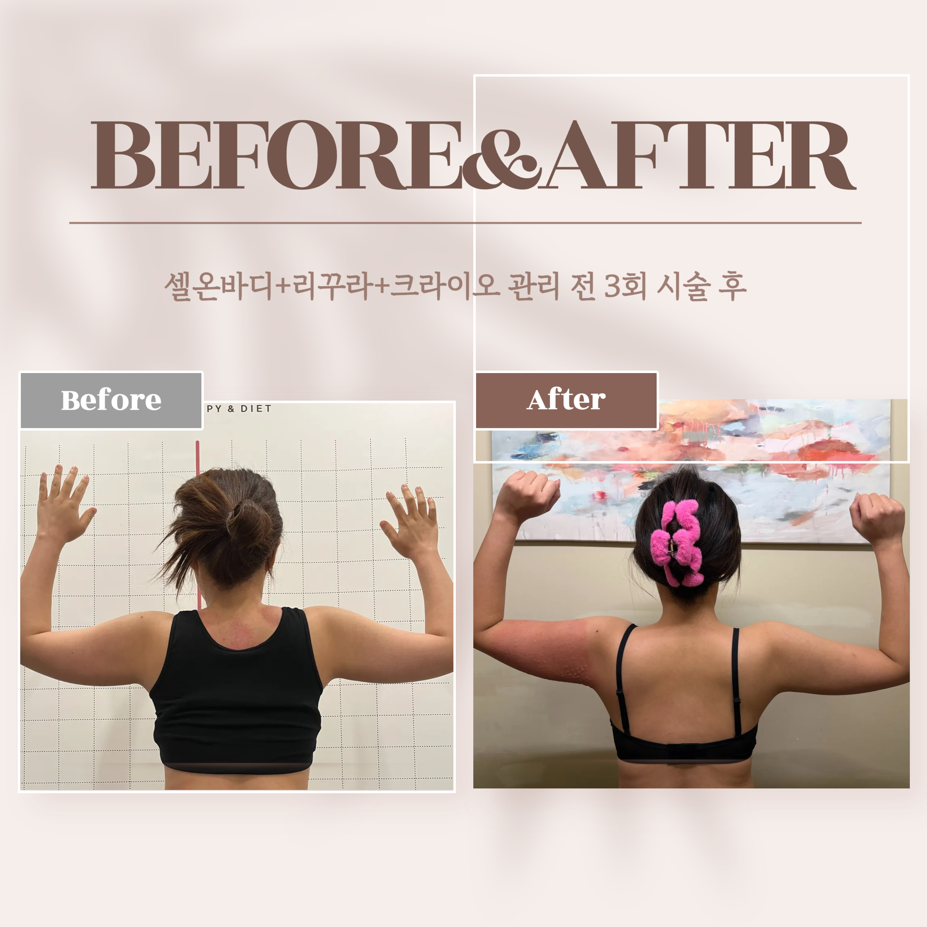 에르모크라이오테라피&다이어트