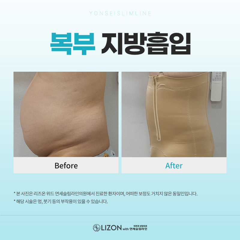 리즈온 위드 연세슬림라인 대표 이미지