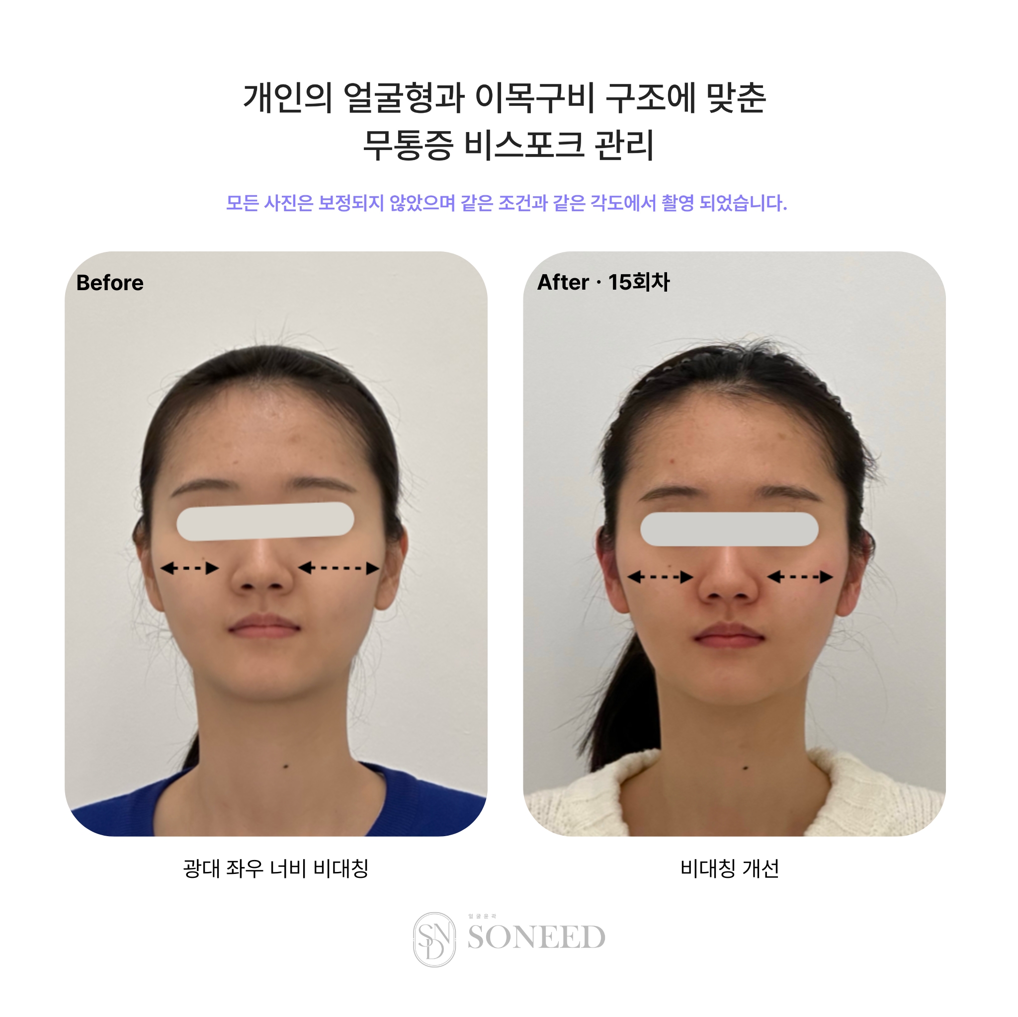 소니드얼굴윤곽 대표 이미지