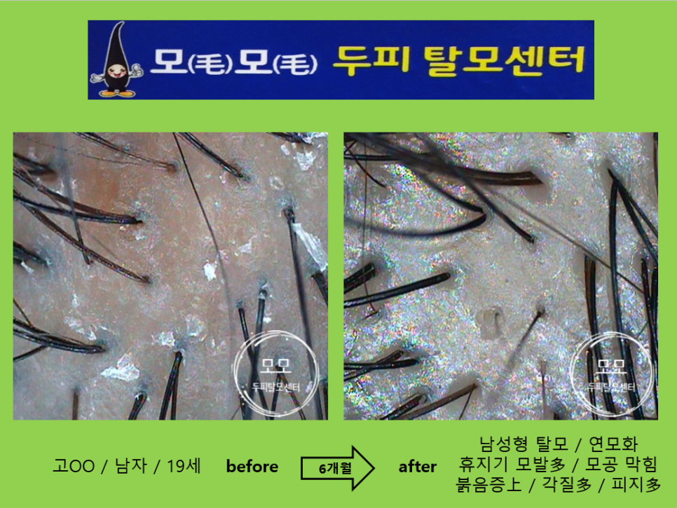 모모두피탈모센터 photo 8