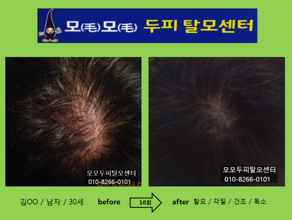 모모두피탈모센터 photo 4