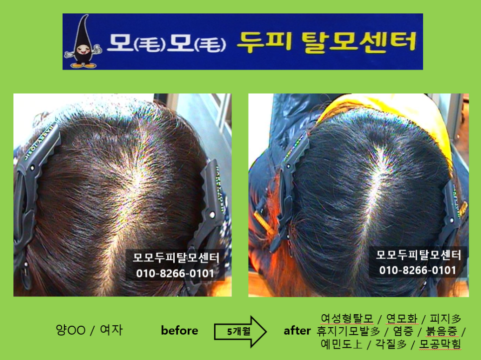 모모두피탈모센터 photo 6
